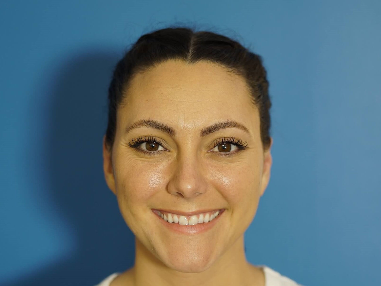 Otoplasty for prominent ears After
