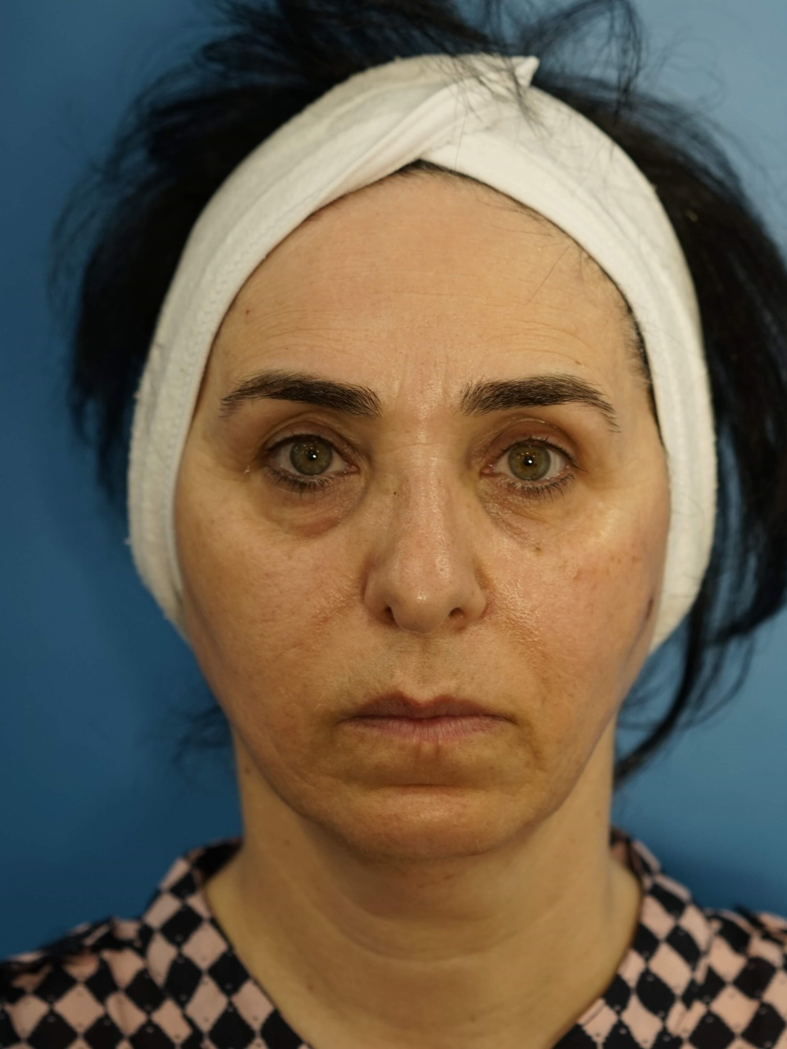 Woman has Lower Bleph Lip Lift Before