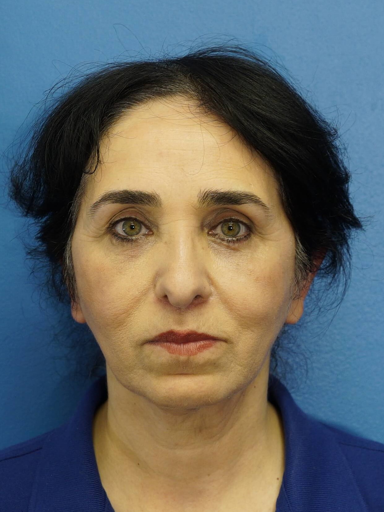 Woman has Lower Bleph Lip Lift After