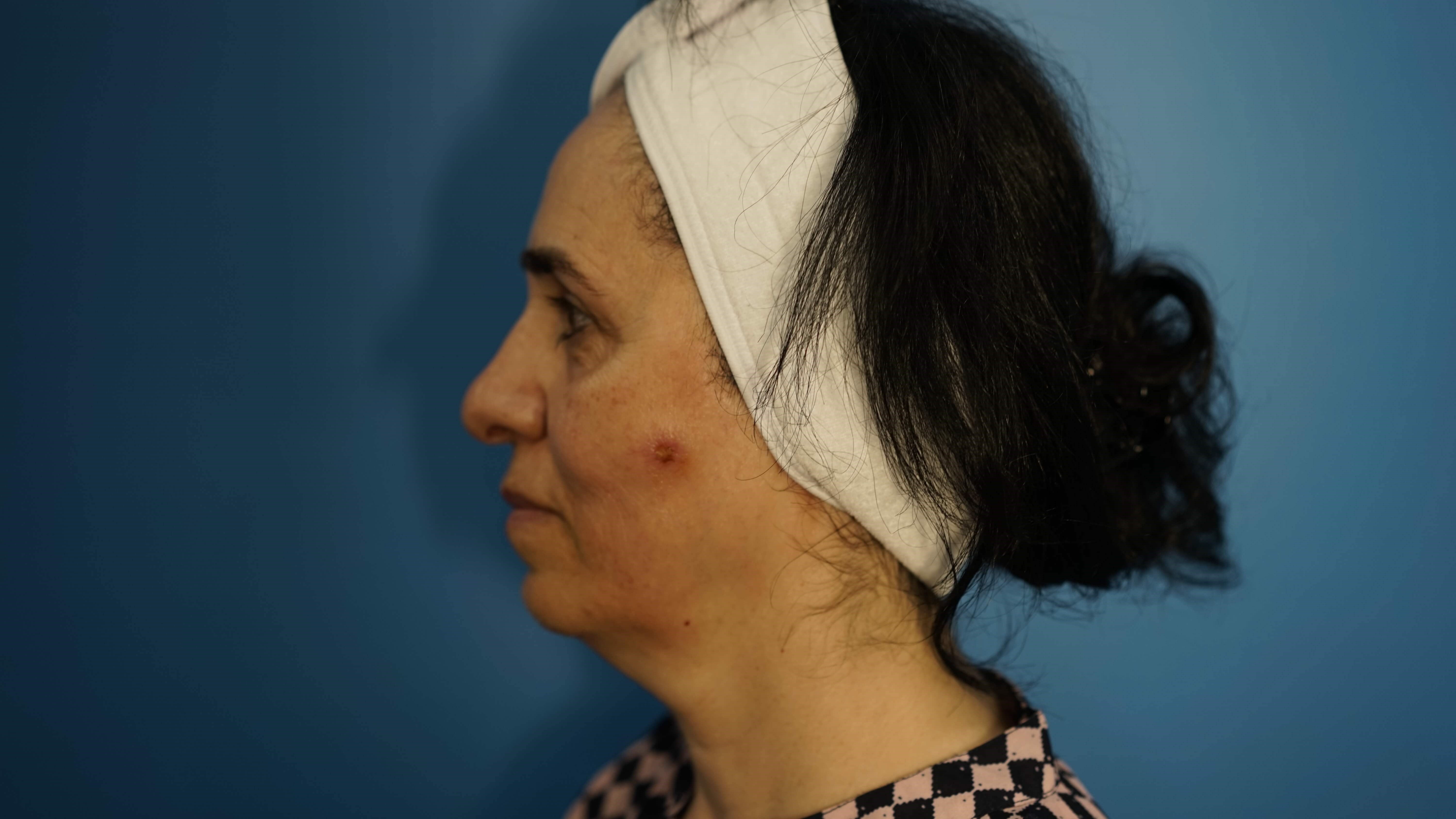 Woman has Lower Bleph Lip Lift Before