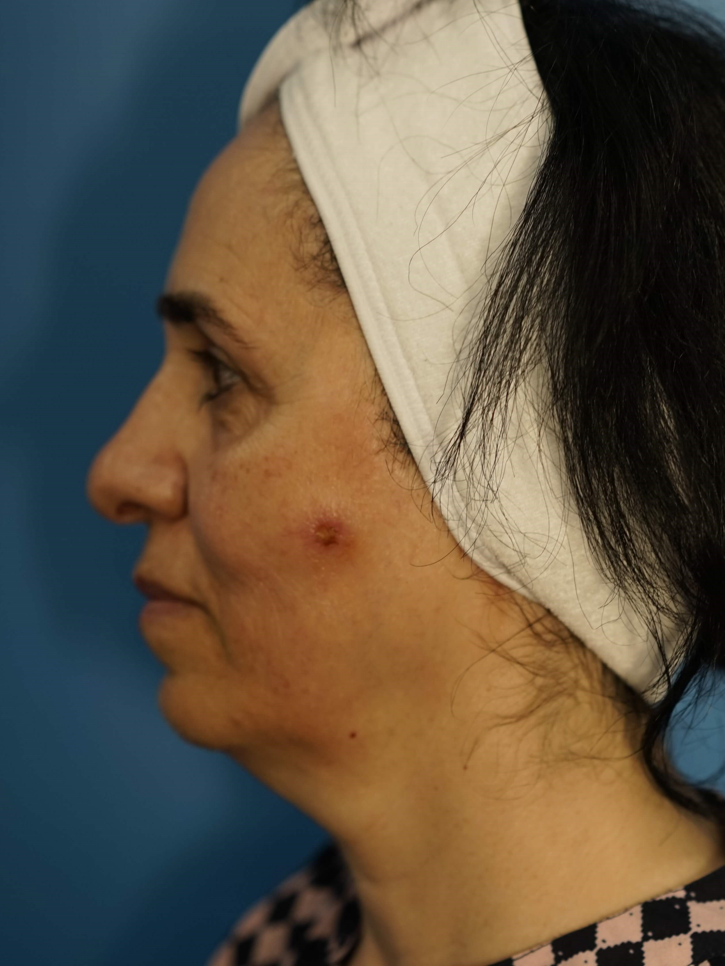 Woman has Lower Bleph Lip Lift Before