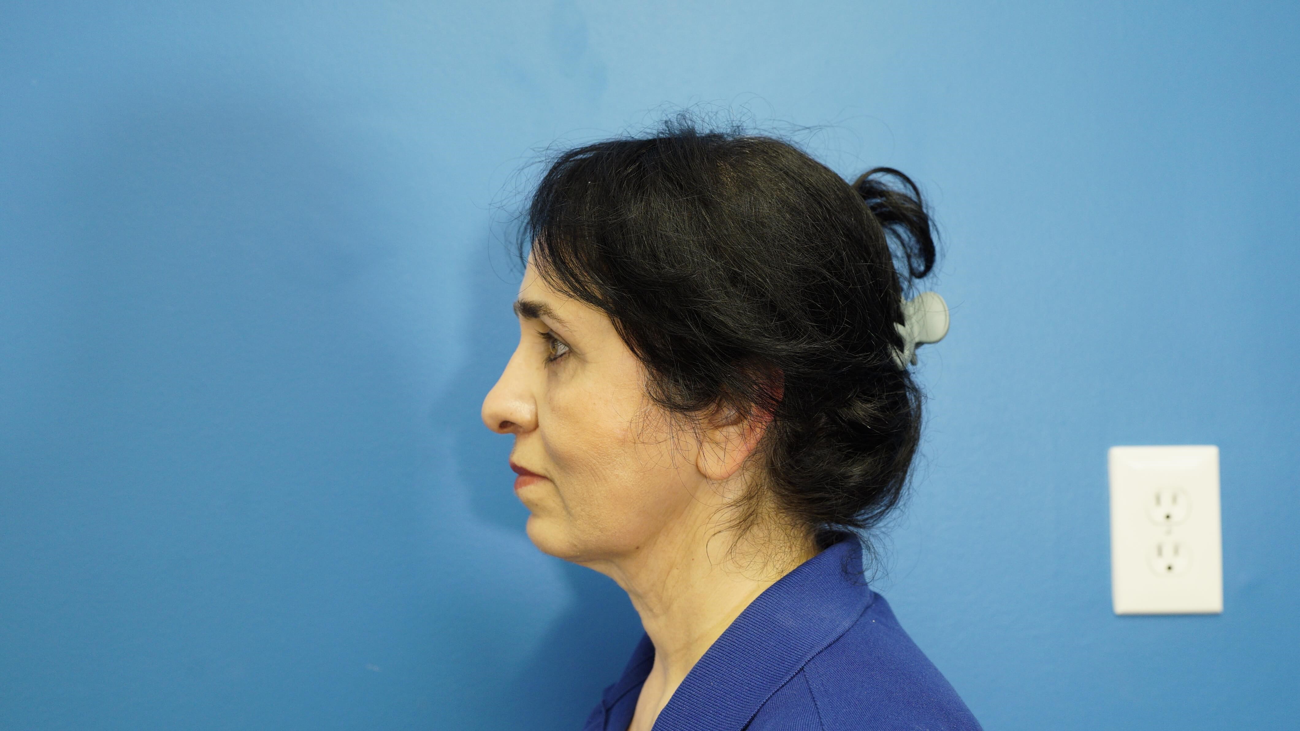 Woman has Lower Bleph Lip Lift After