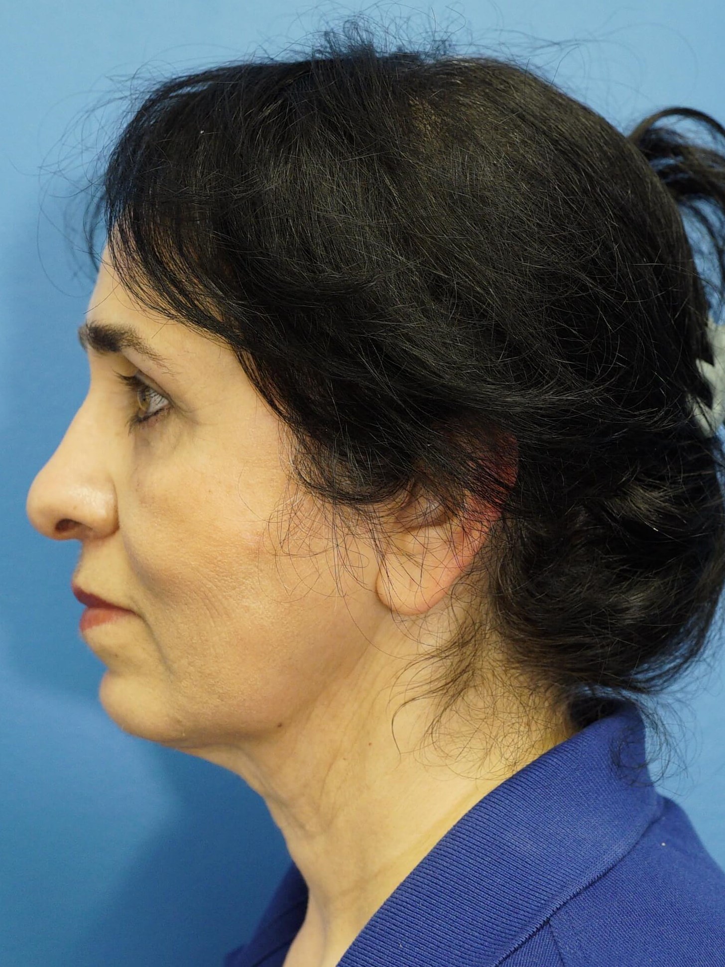 Woman has Lower Bleph Lip Lift After