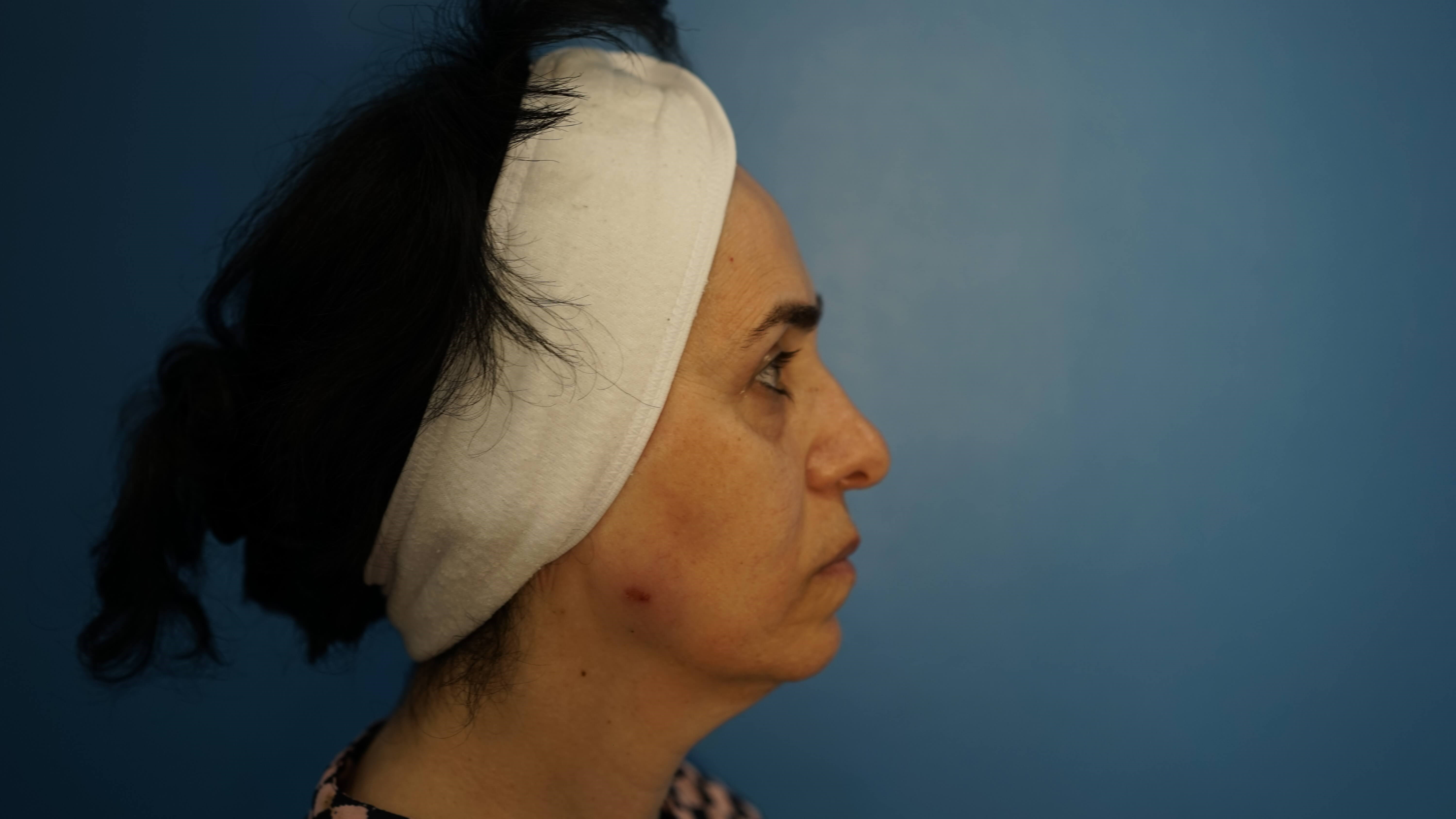 Woman has Lower Bleph Lip Lift Before