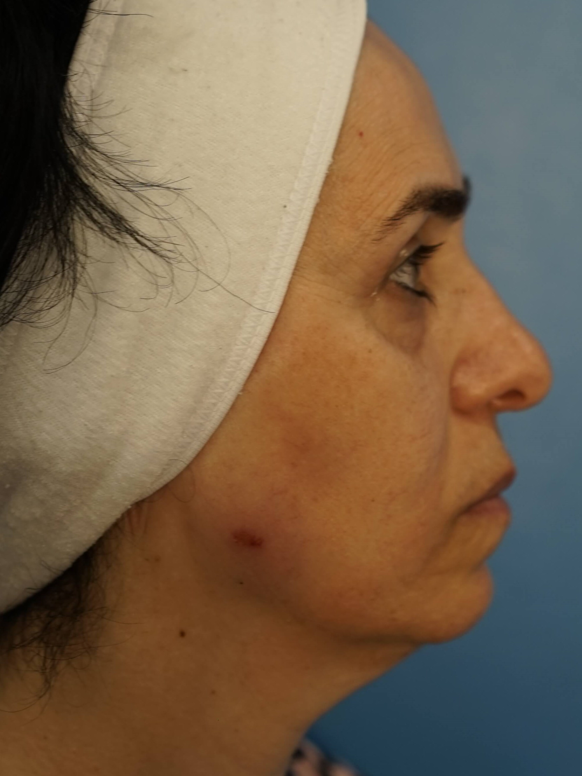 Woman has Lower Bleph Lip Lift Before