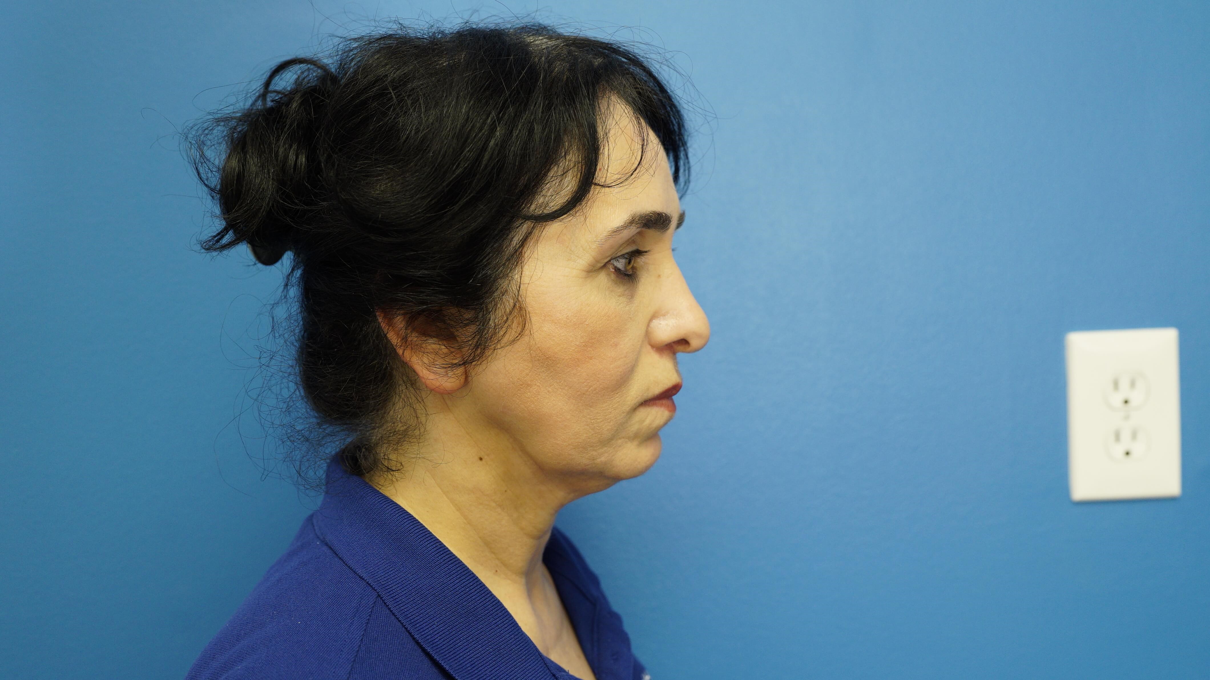 Woman has Lower Bleph Lip Lift After