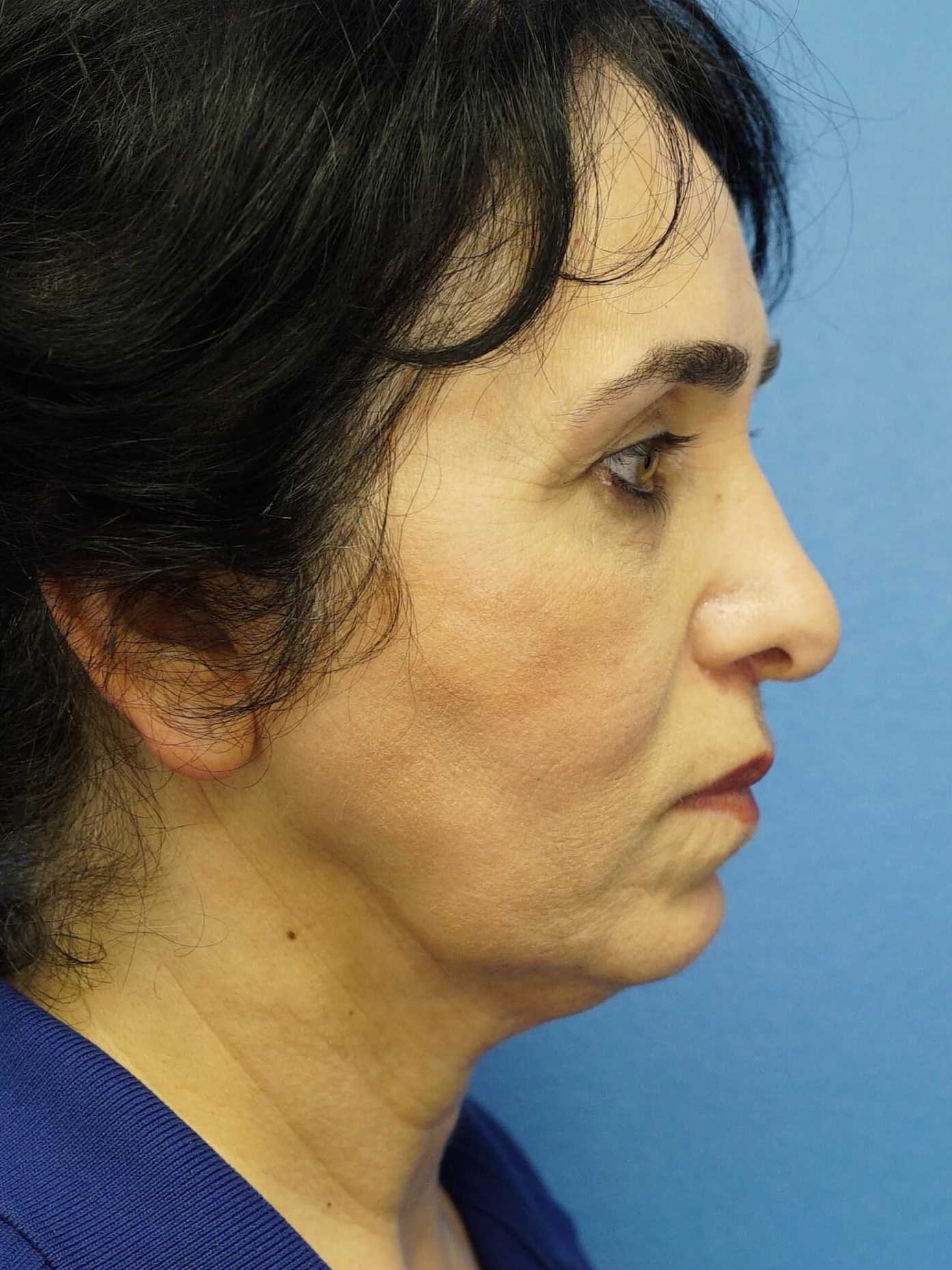 Woman has Lower Bleph Lip Lift After