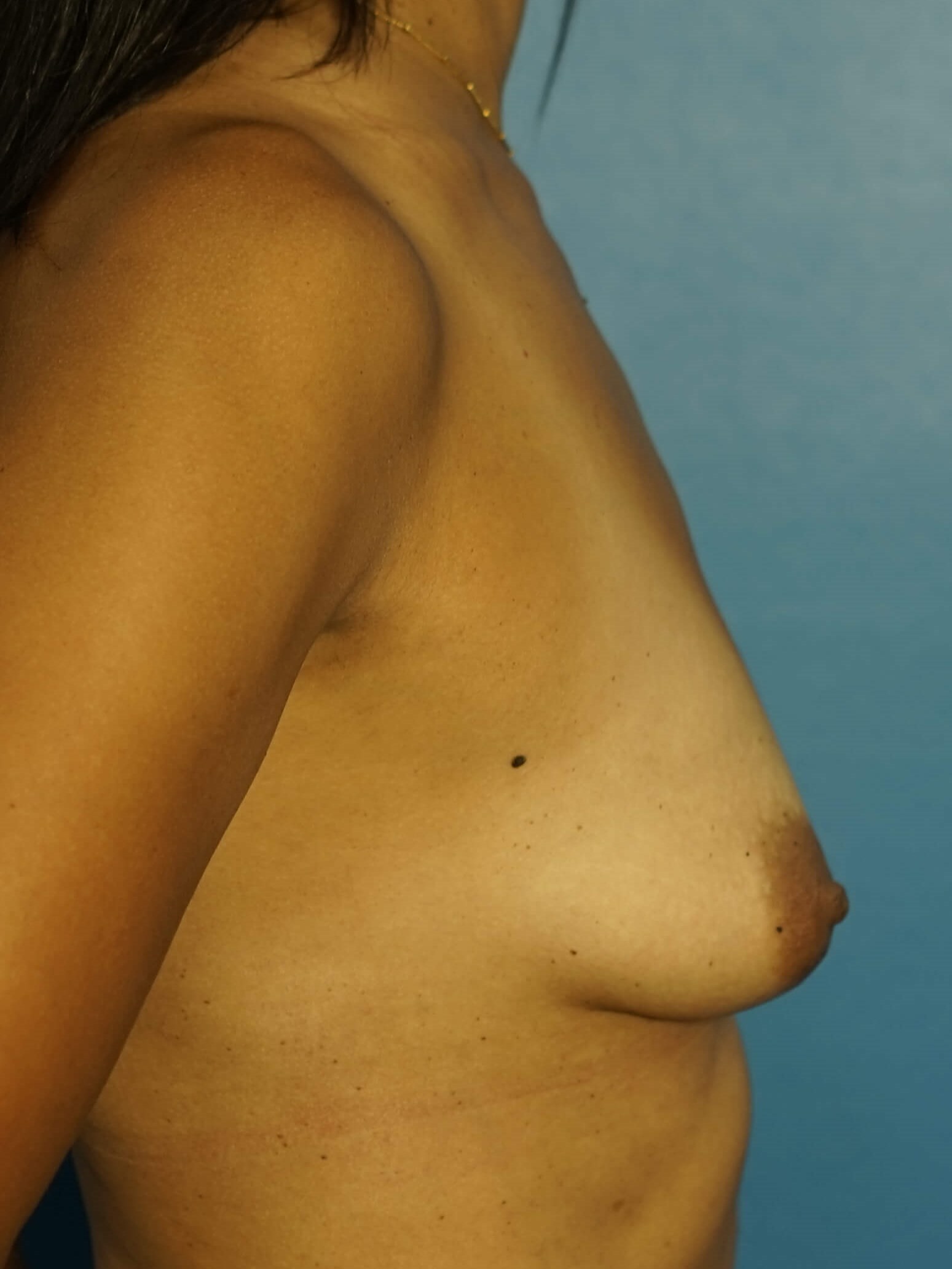 Westlake Woman Has Breast Aug Before