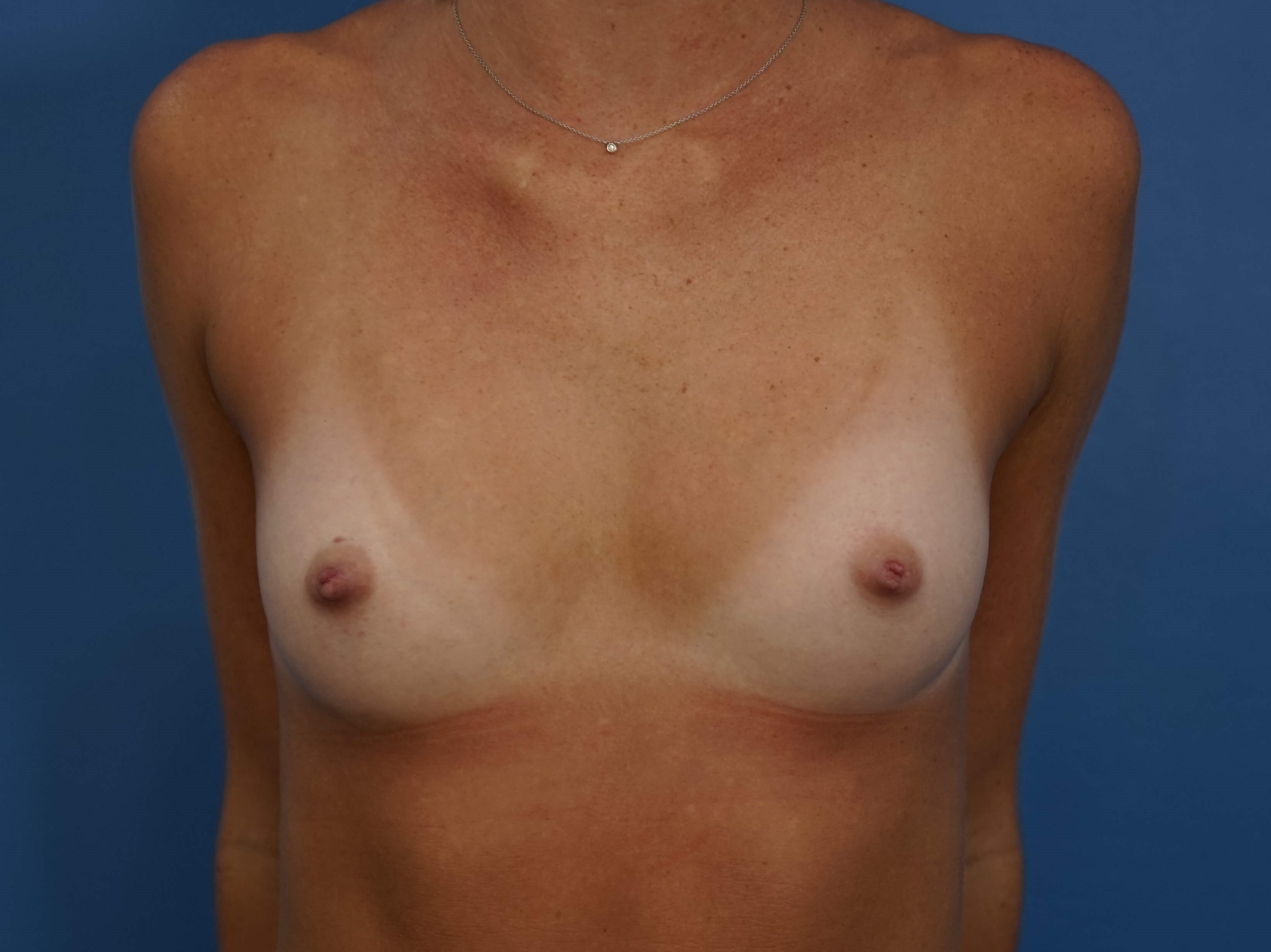 Westlake Woman Has Breast Aug Before