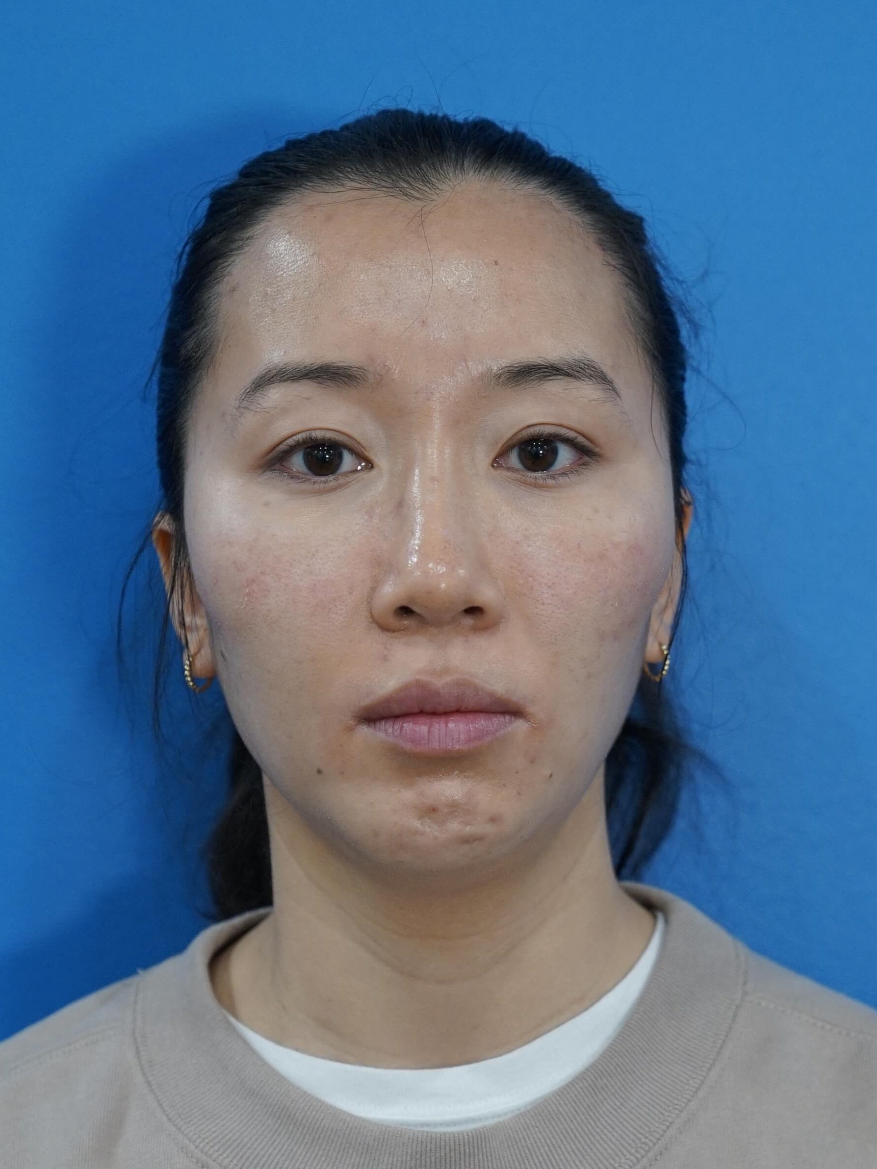 Westlake Woman Has Cheek Aug After