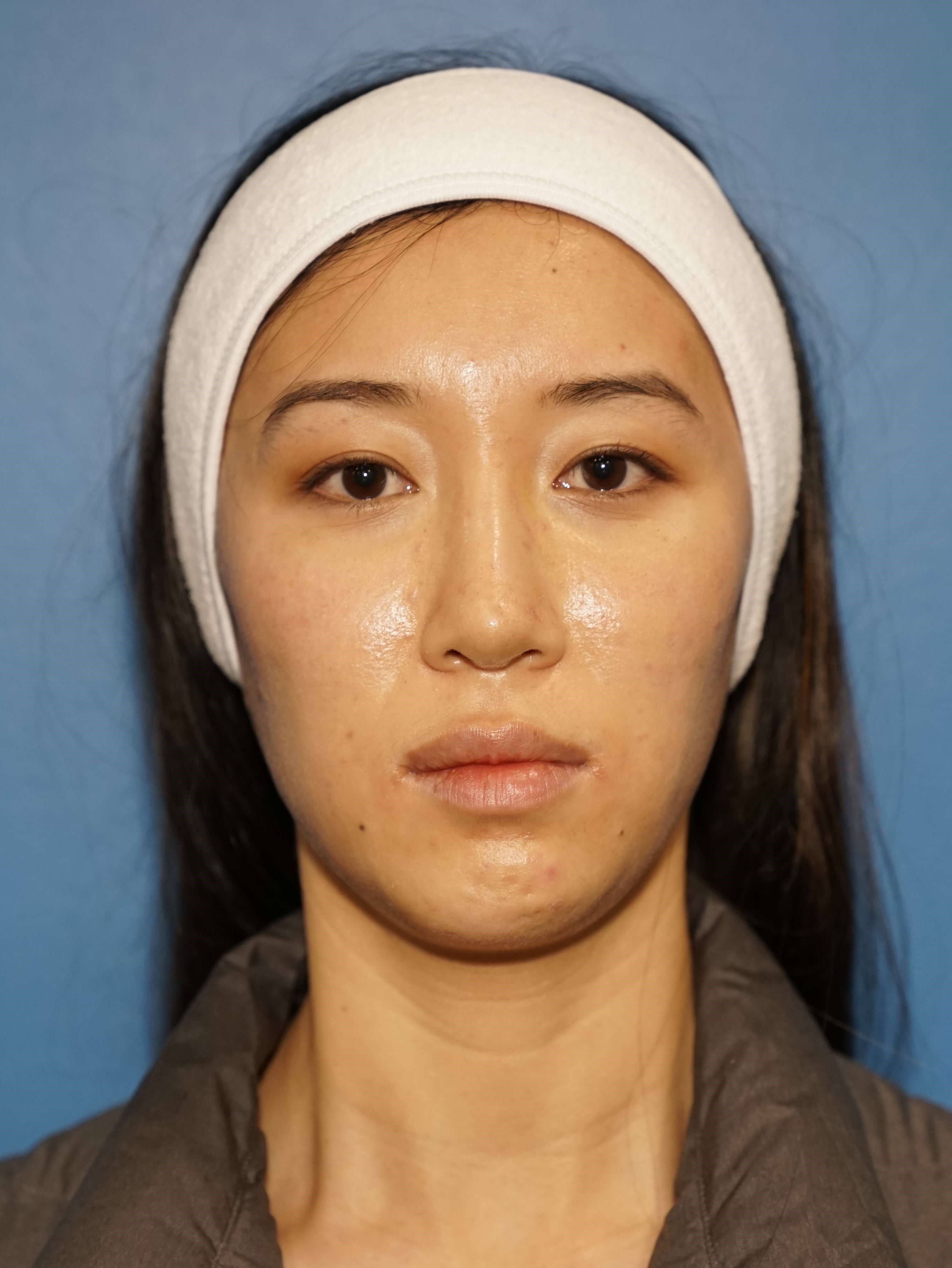 Westlake Woman Has Cheek Aug Before