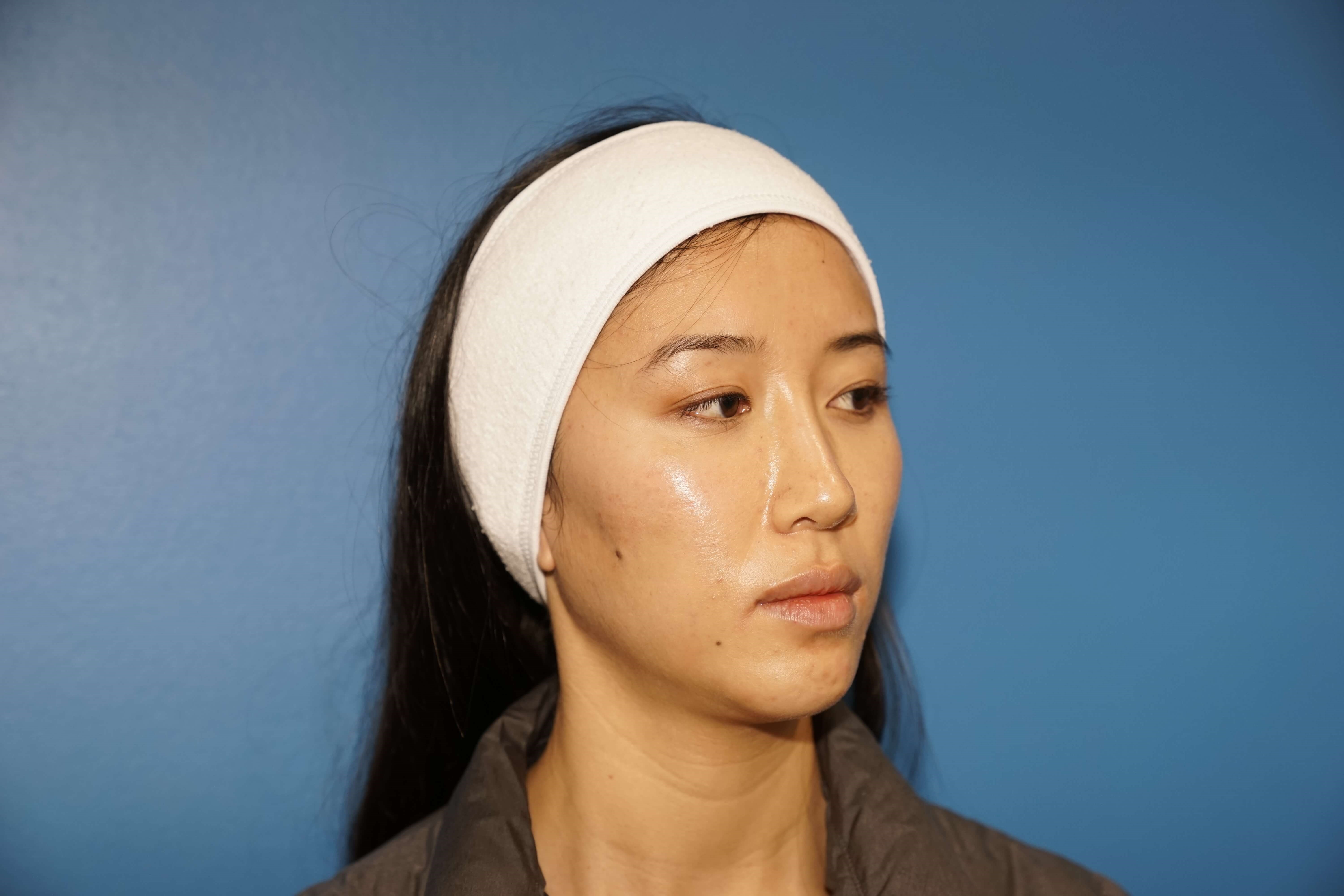 Westlake Woman Has Cheek Aug Before