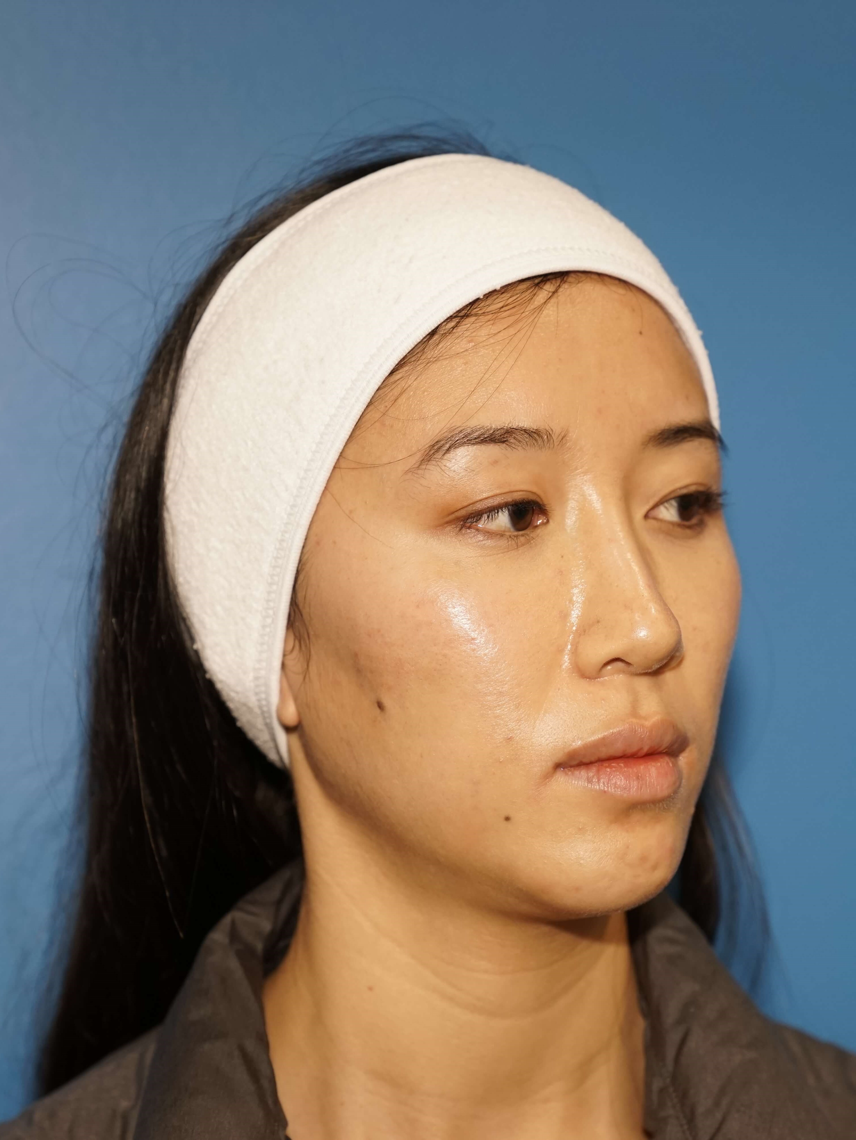 Westlake Woman Has Cheek Aug Before