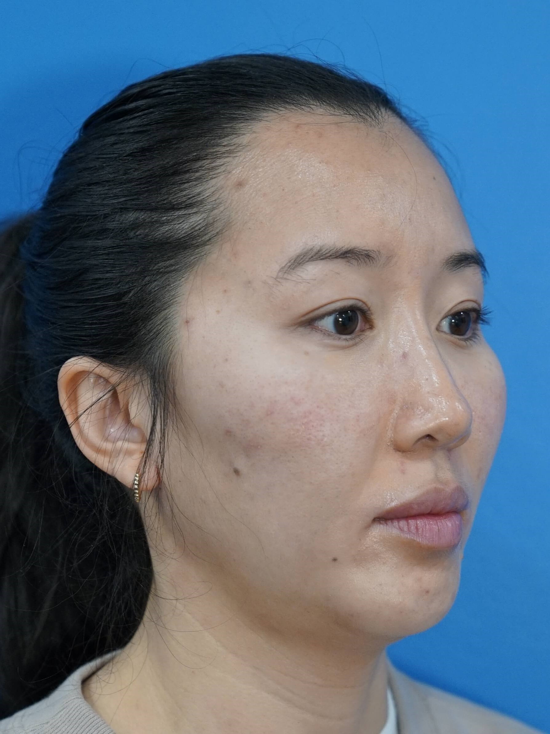 Westlake Woman Has Cheek Aug After