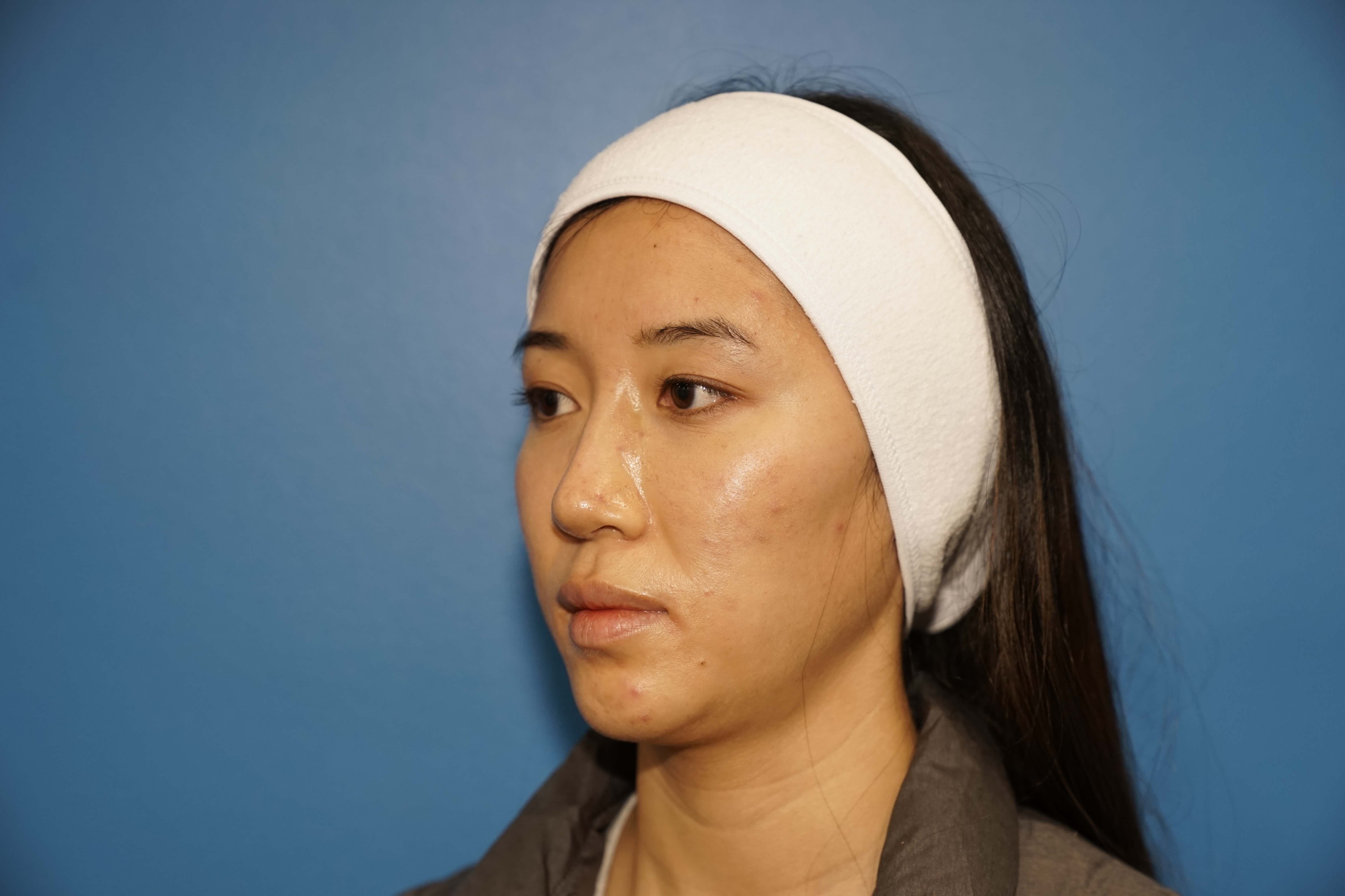 Westlake Woman Has Cheek Aug Before
