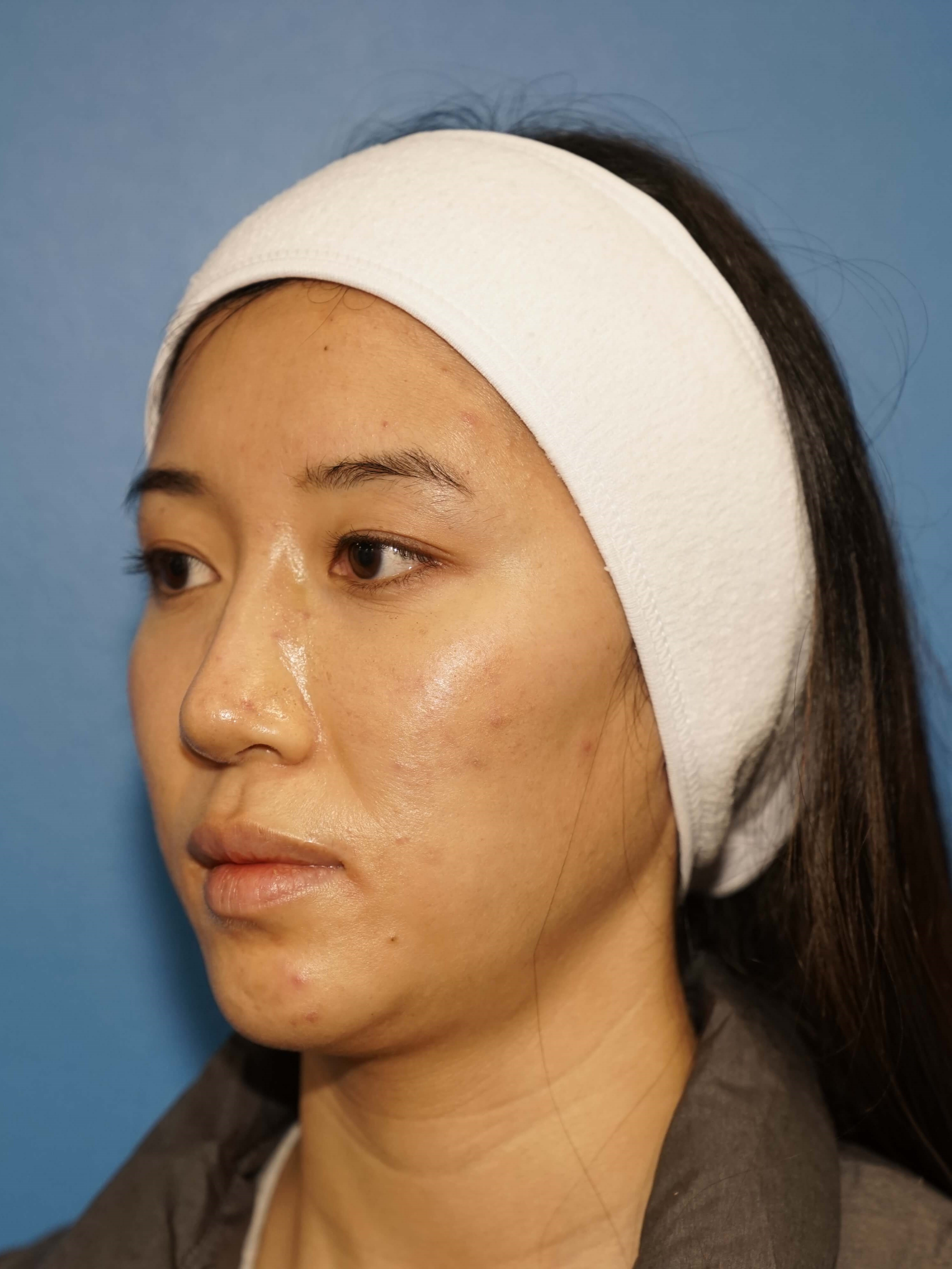 Westlake Woman Has Cheek Aug Before