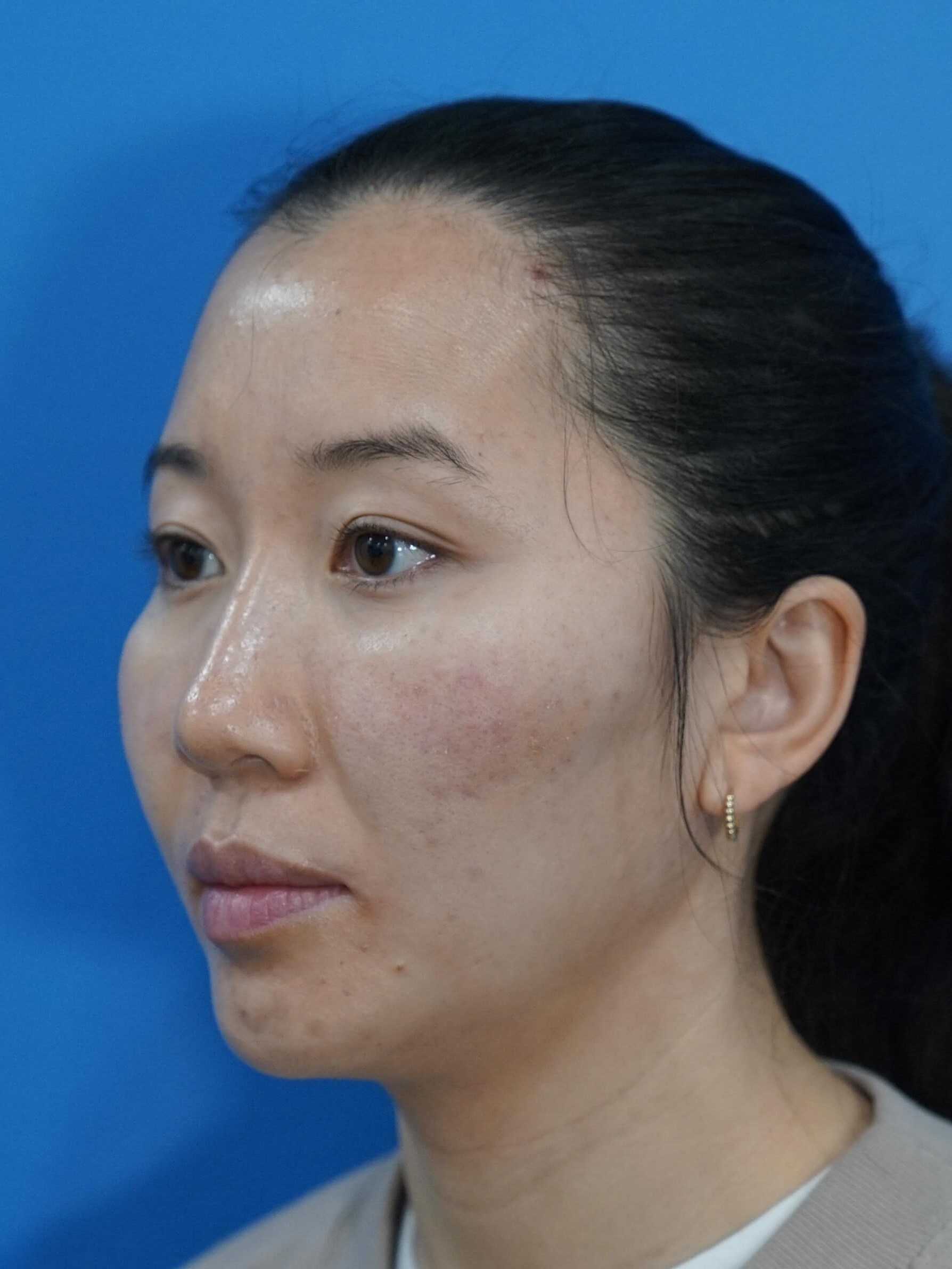 Westlake Woman Has Cheek Aug After