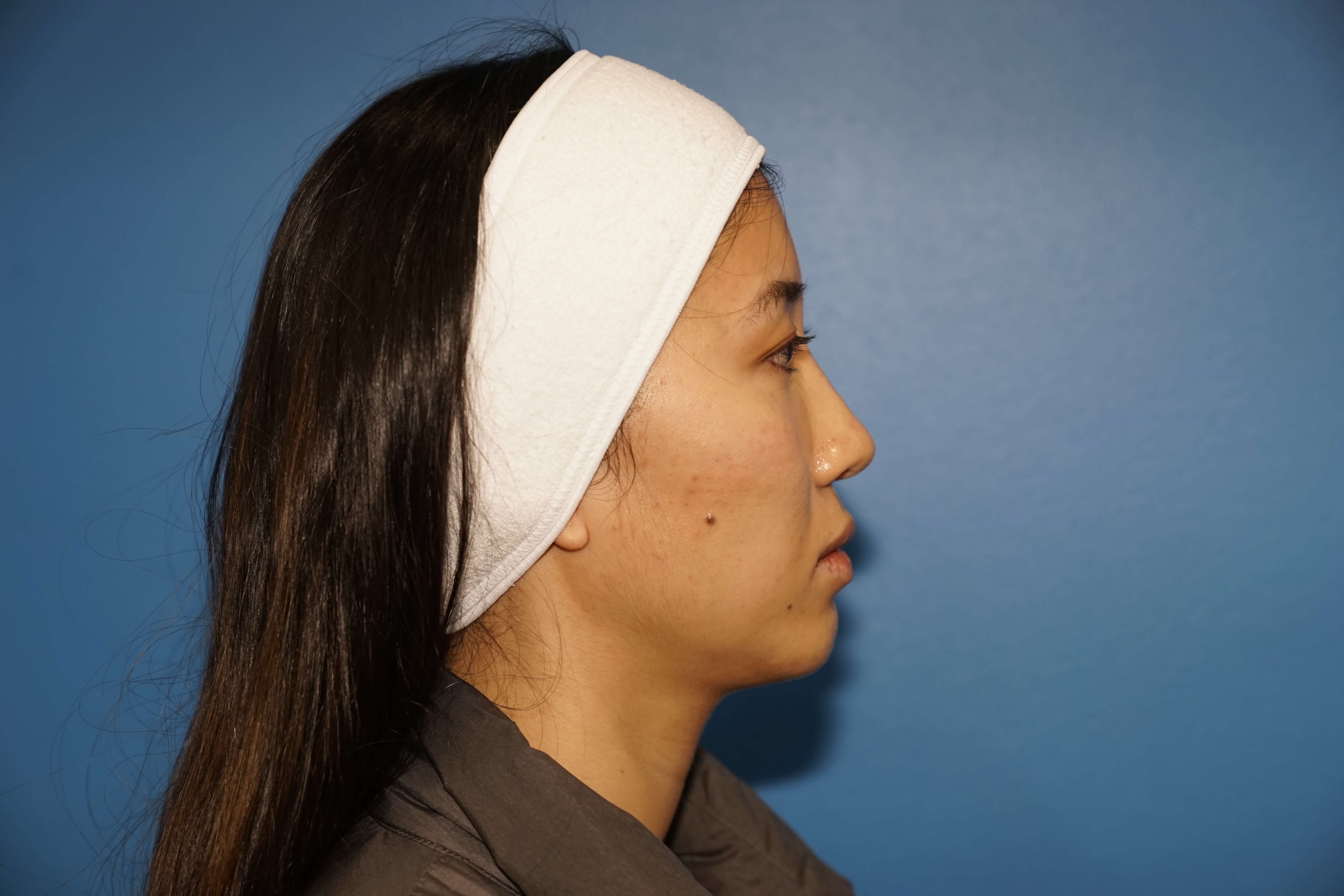 Westlake Woman Has Cheek Aug Before