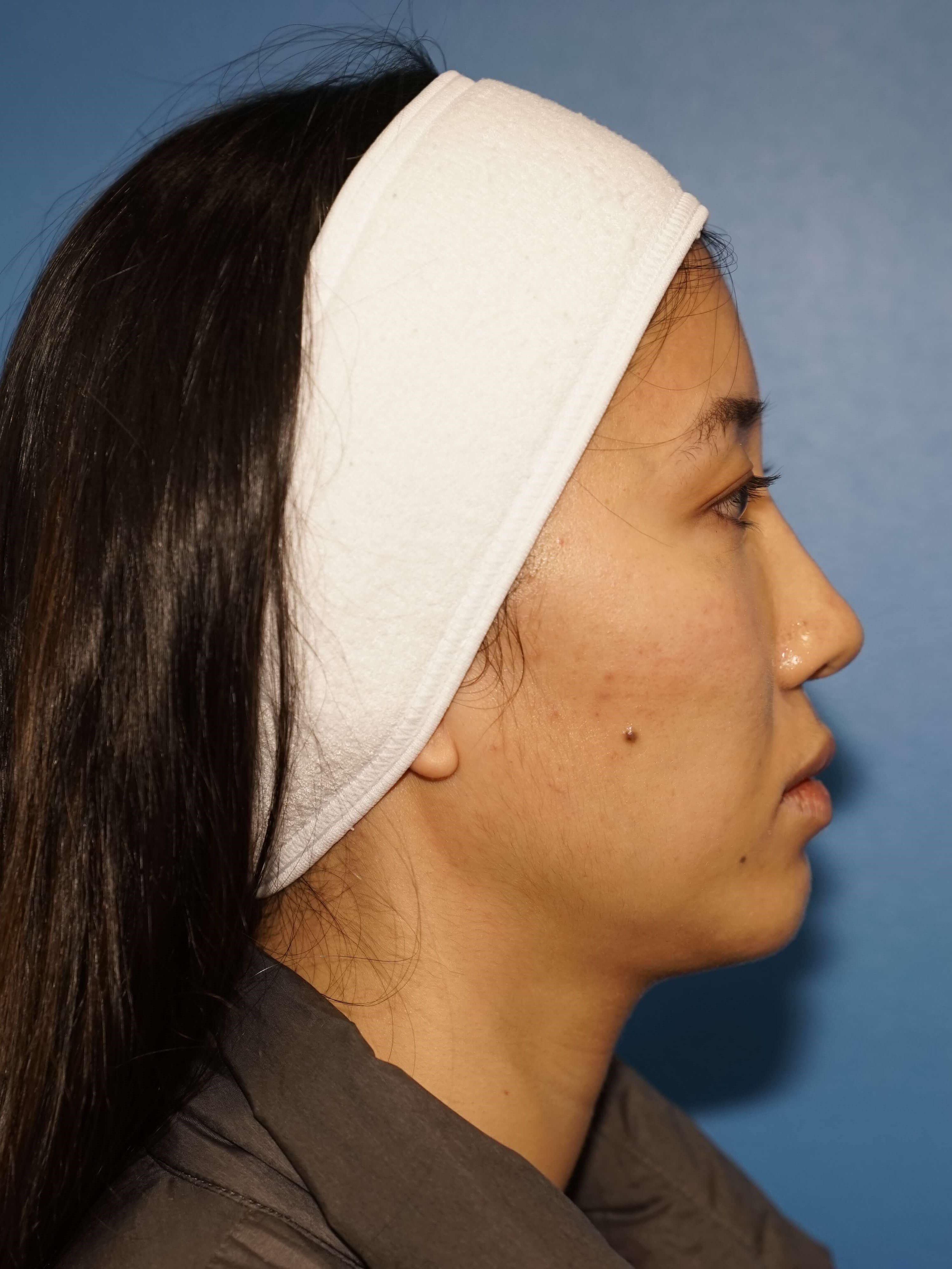 Westlake Woman Has Cheek Aug Before