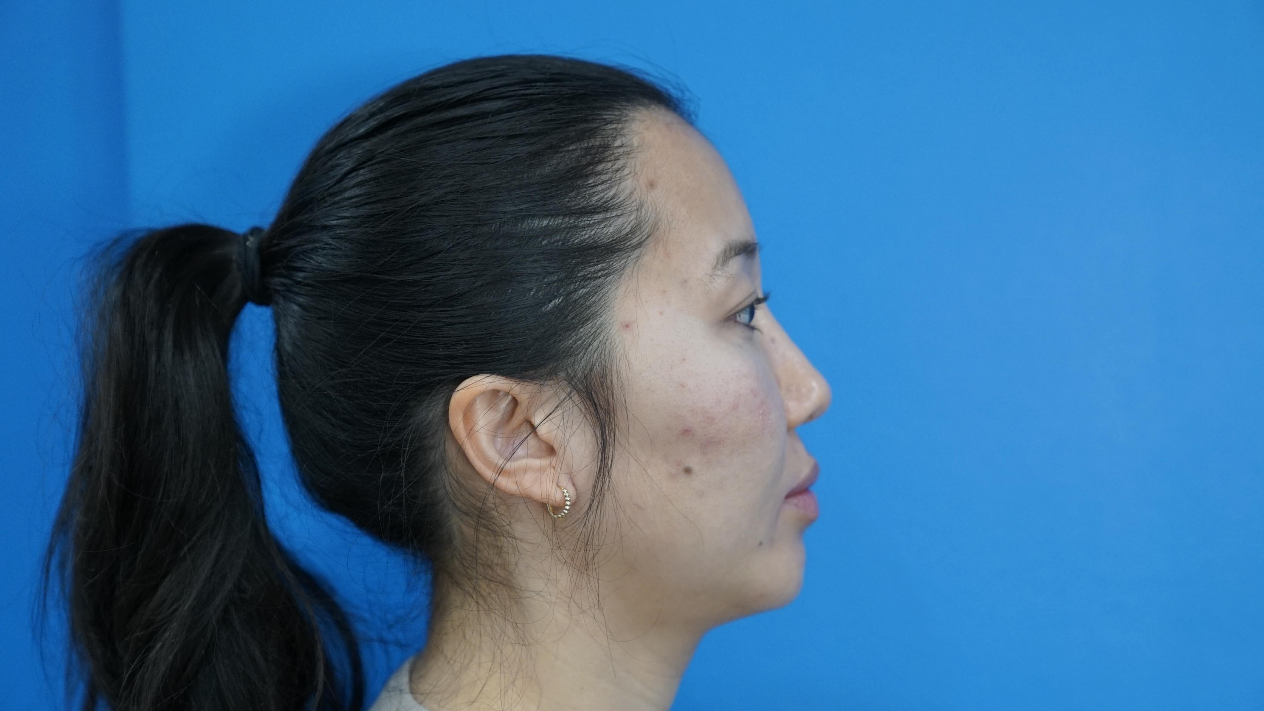 Westlake Woman Has Cheek Aug After