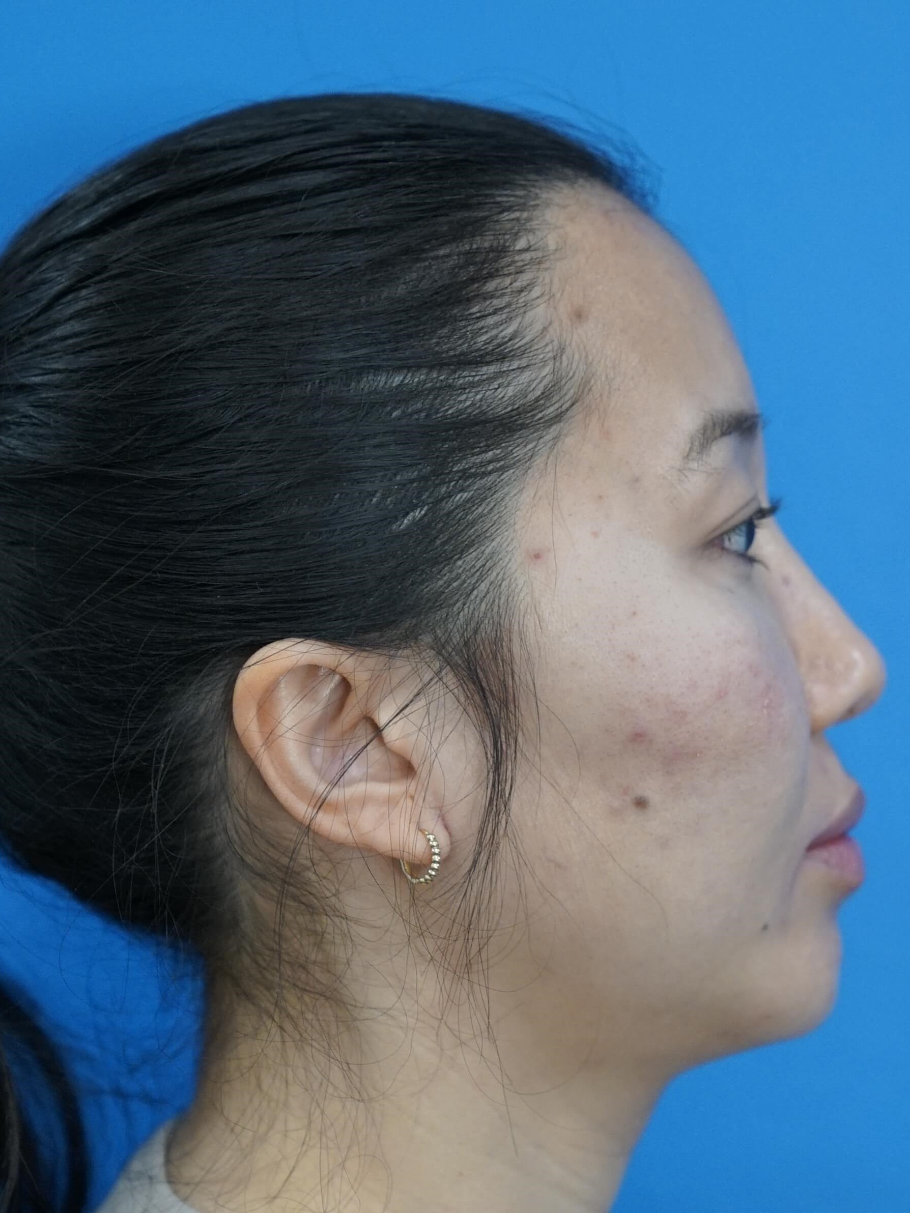 Westlake Woman Has Cheek Aug After