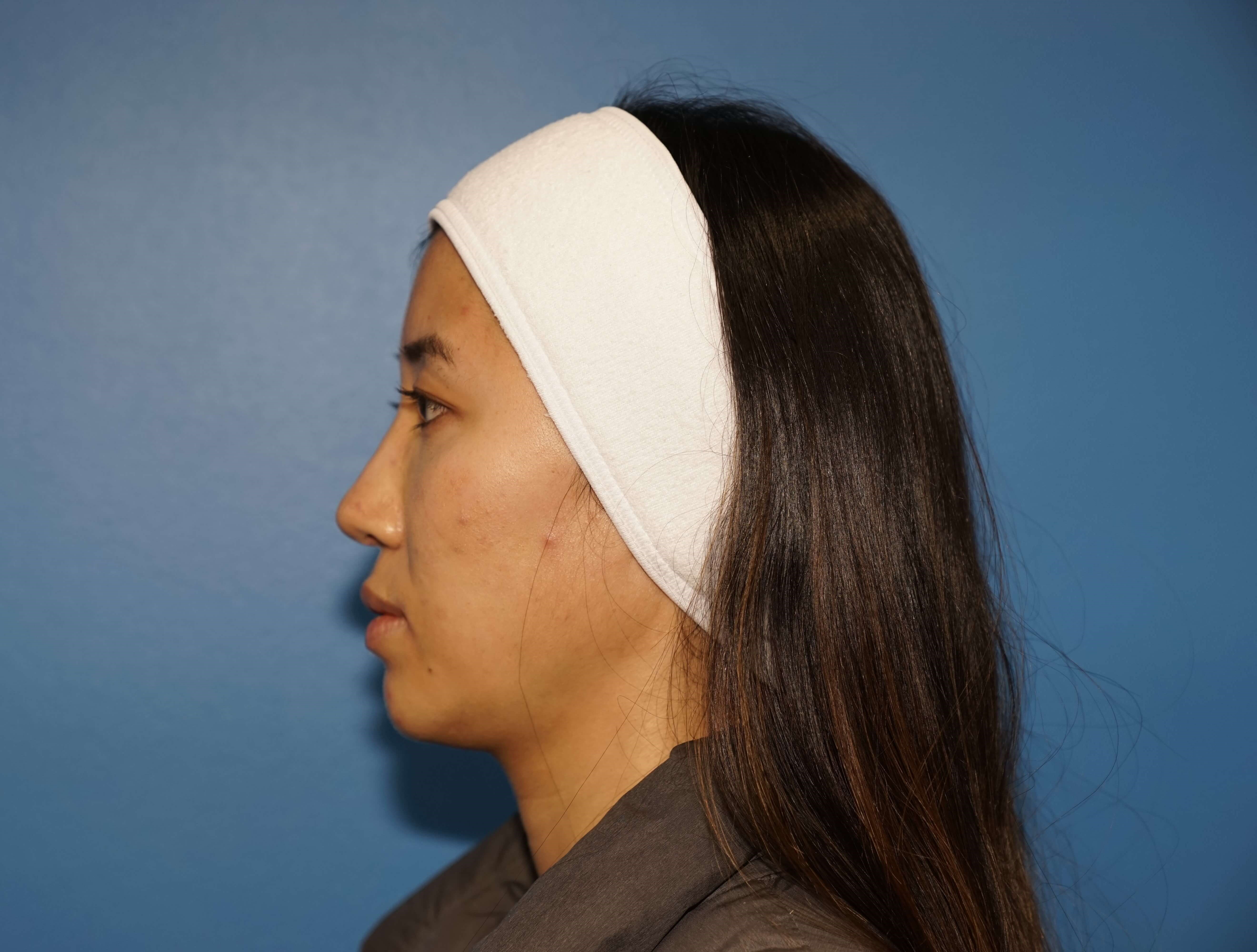 Westlake Woman Has Cheek Aug Before