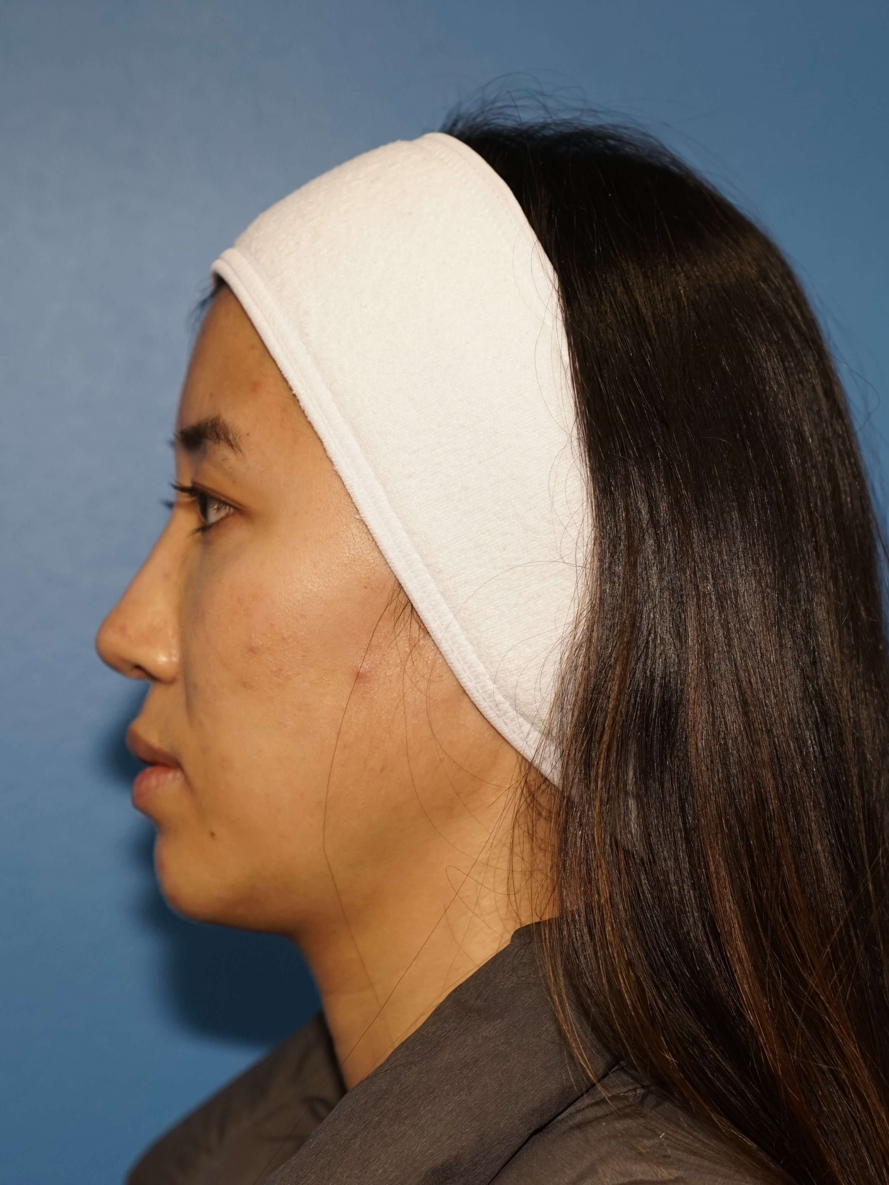 Westlake Woman Has Cheek Aug Before