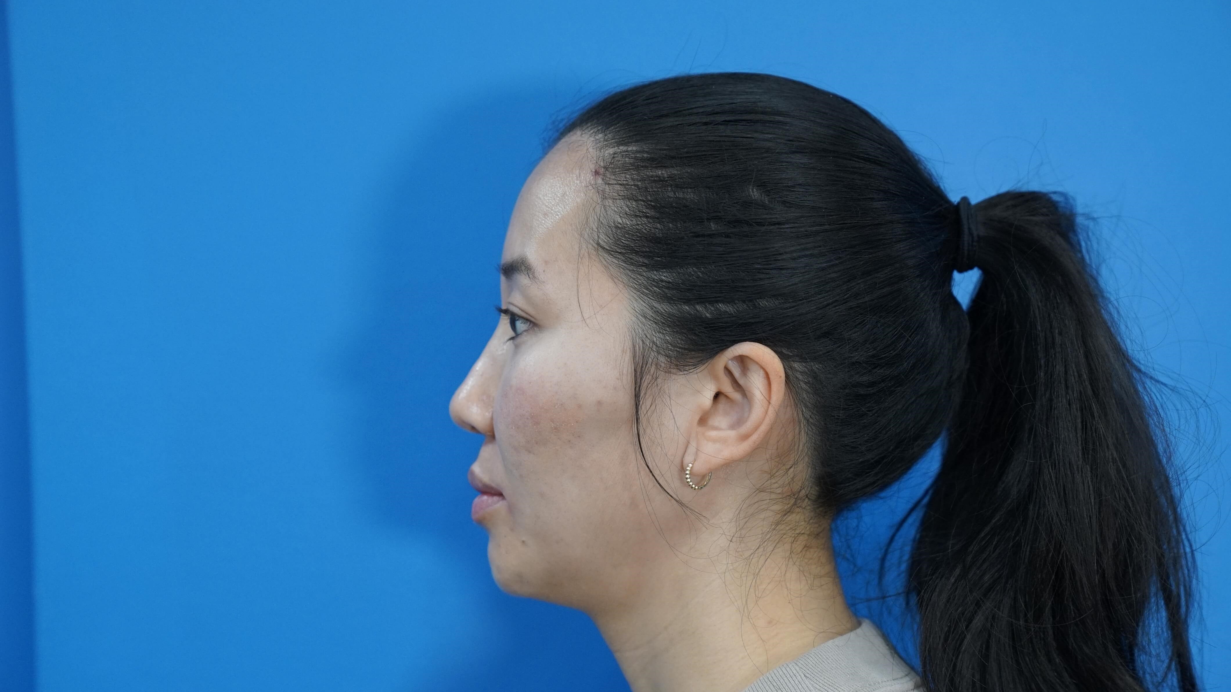 Westlake Woman Has Cheek Aug After