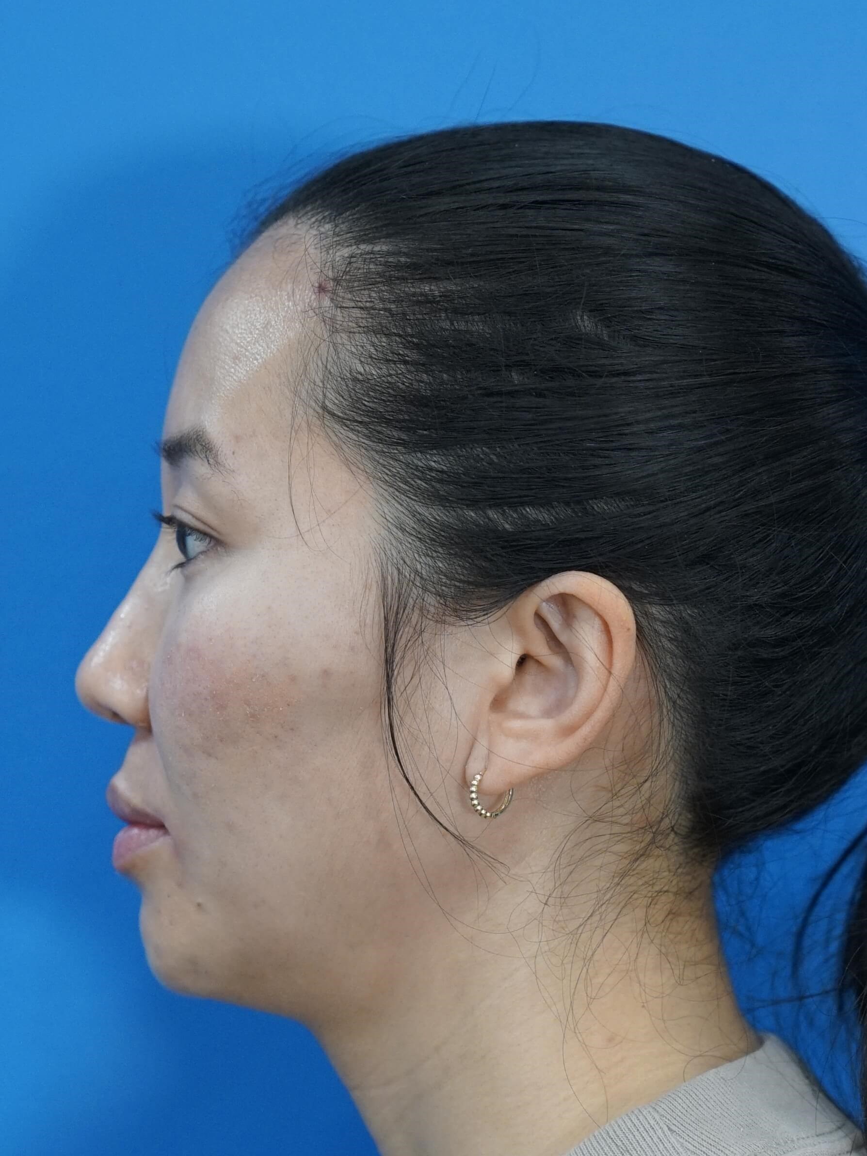 Westlake Woman Has Cheek Aug After