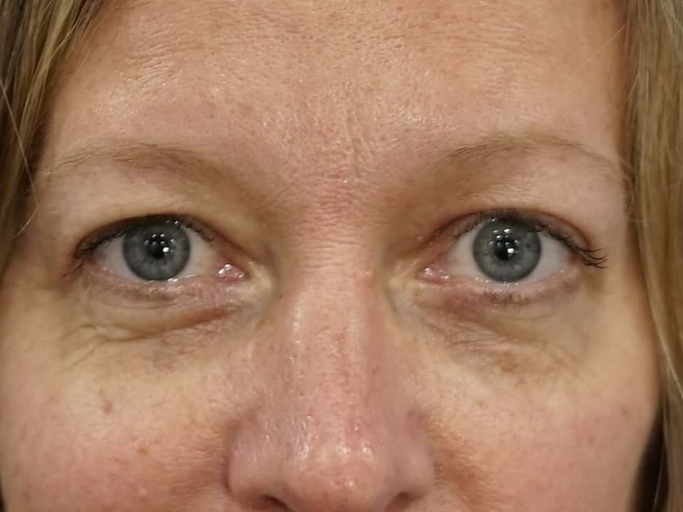 Westlake Woman Has Upper Bleph After