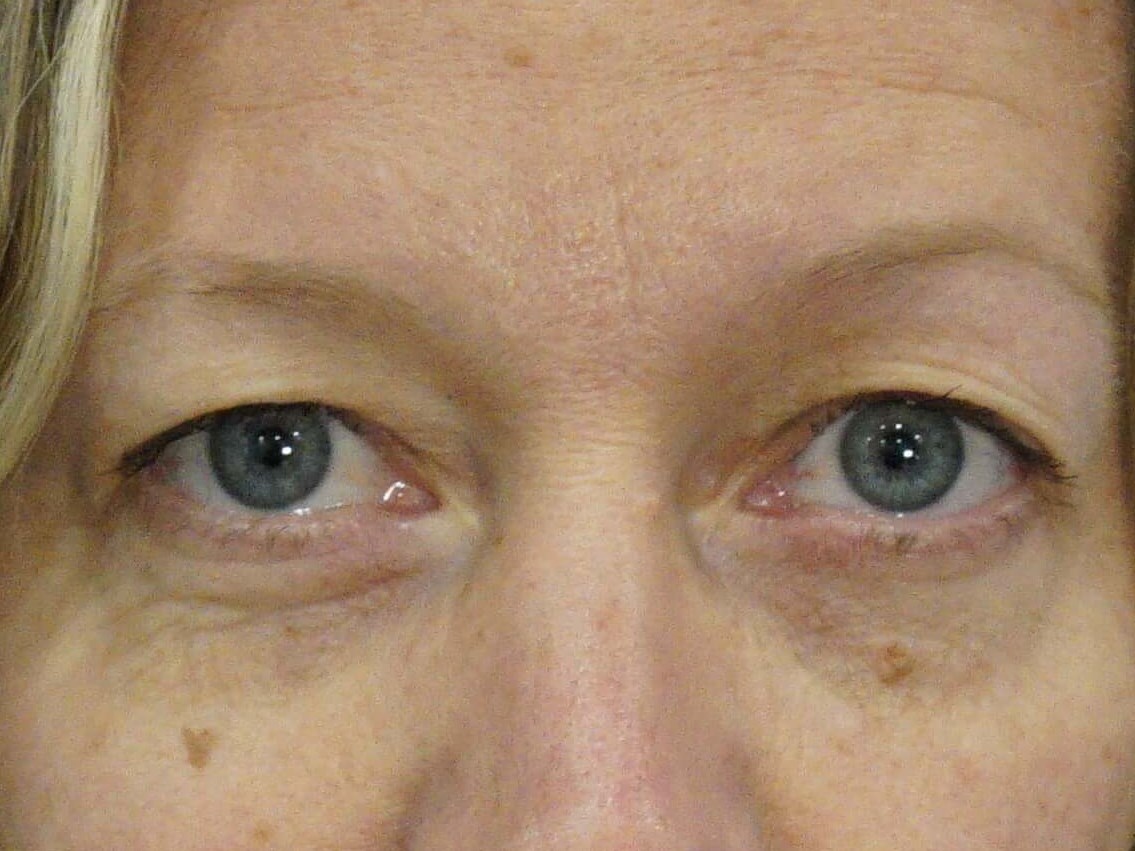 Westlake Woman Has Upper Bleph Before