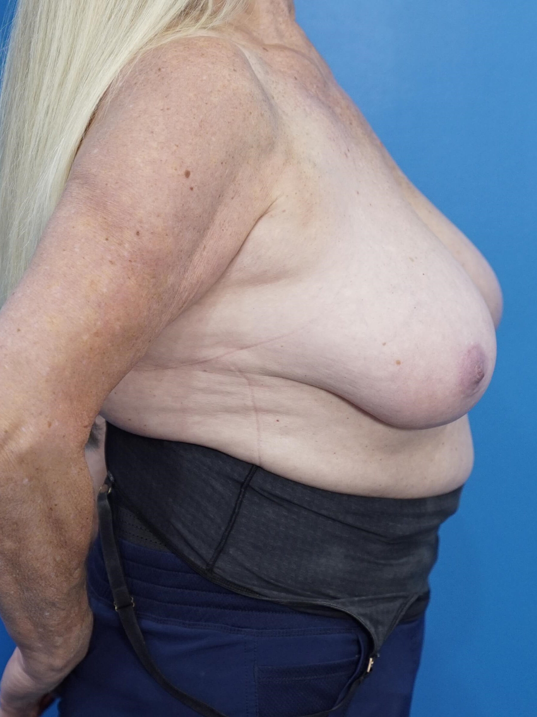 Woman Has Breast Reduction Before