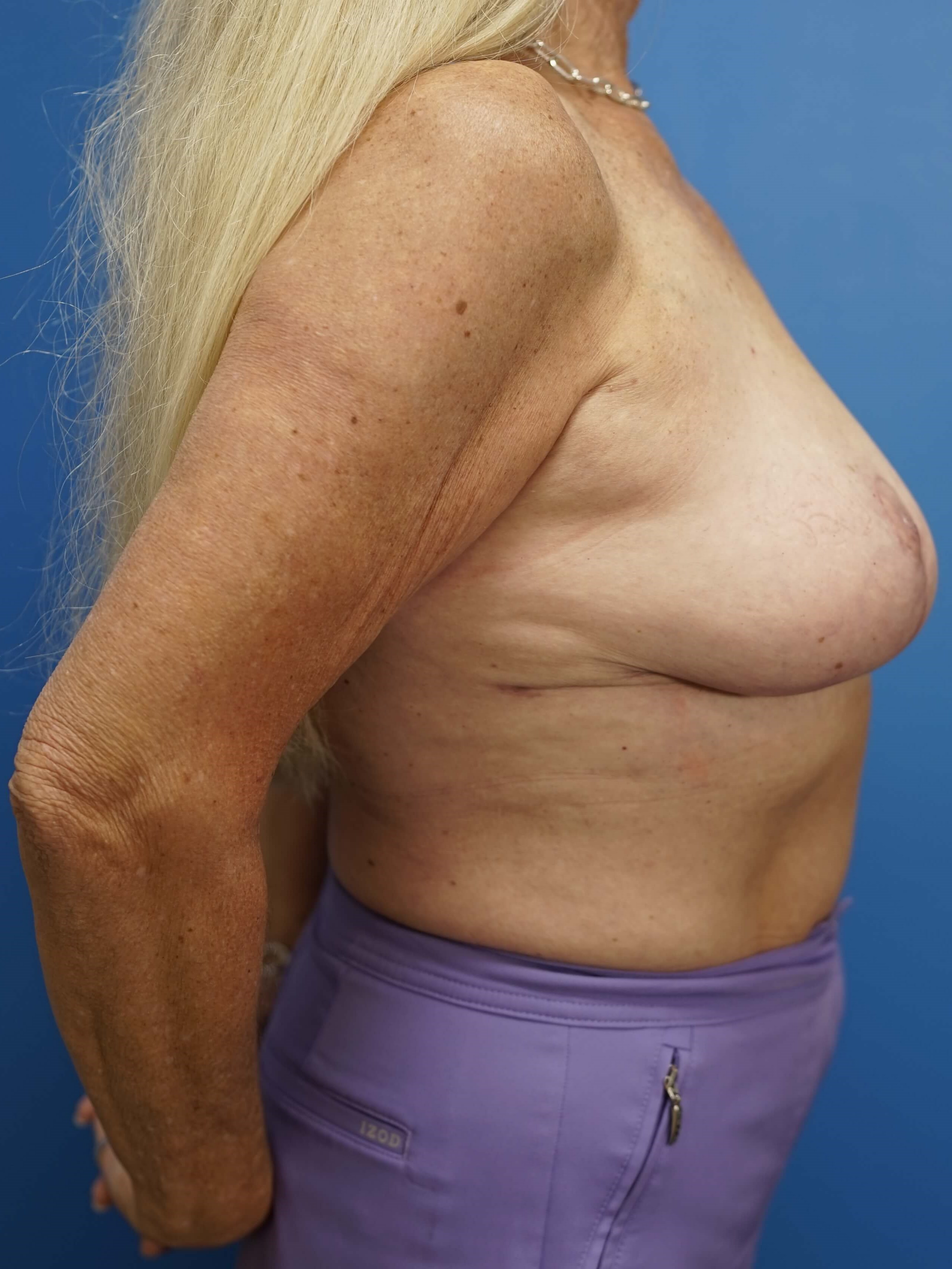Woman Has Breast Reduction After