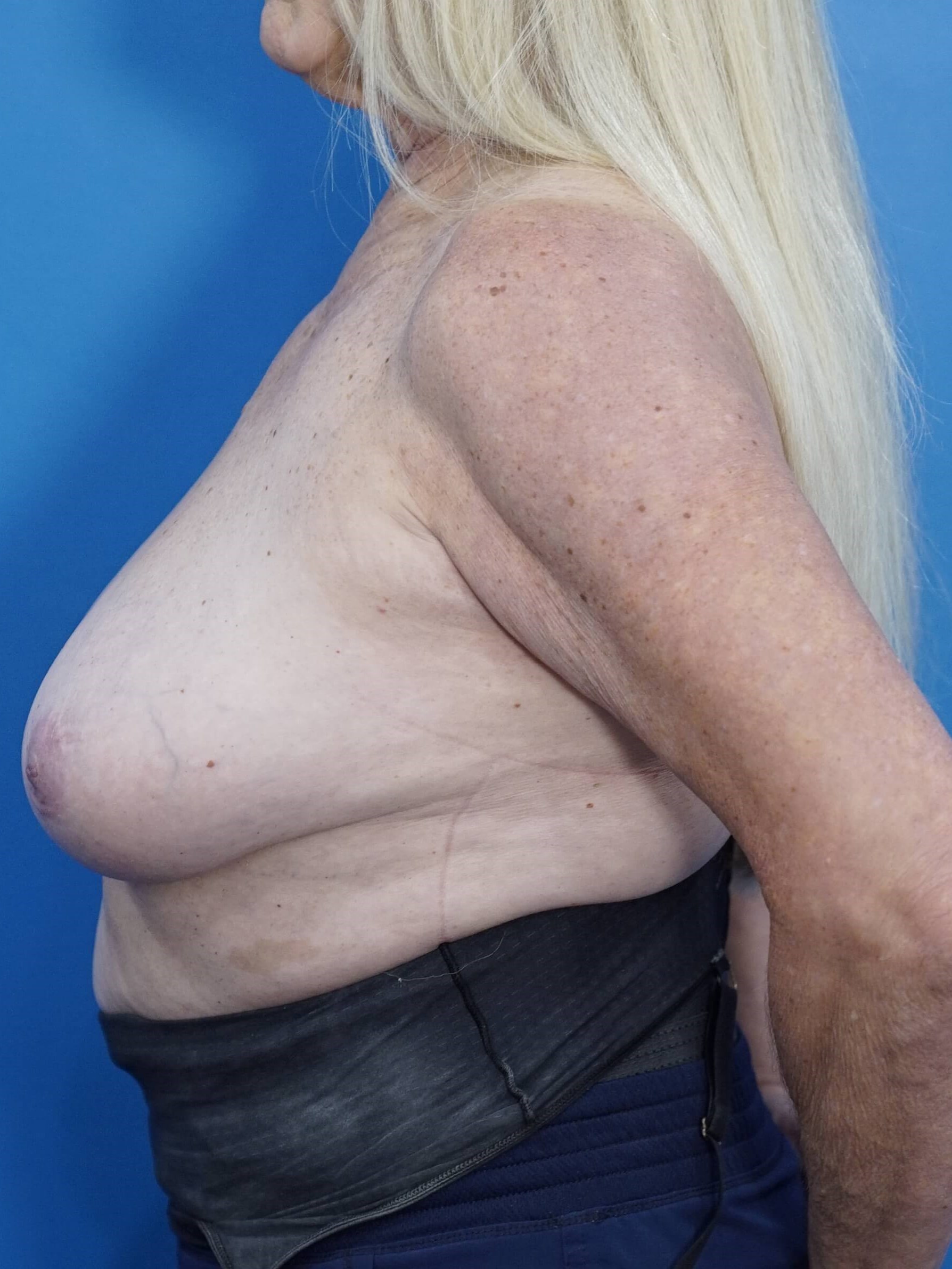 Woman Has Breast Reduction Before