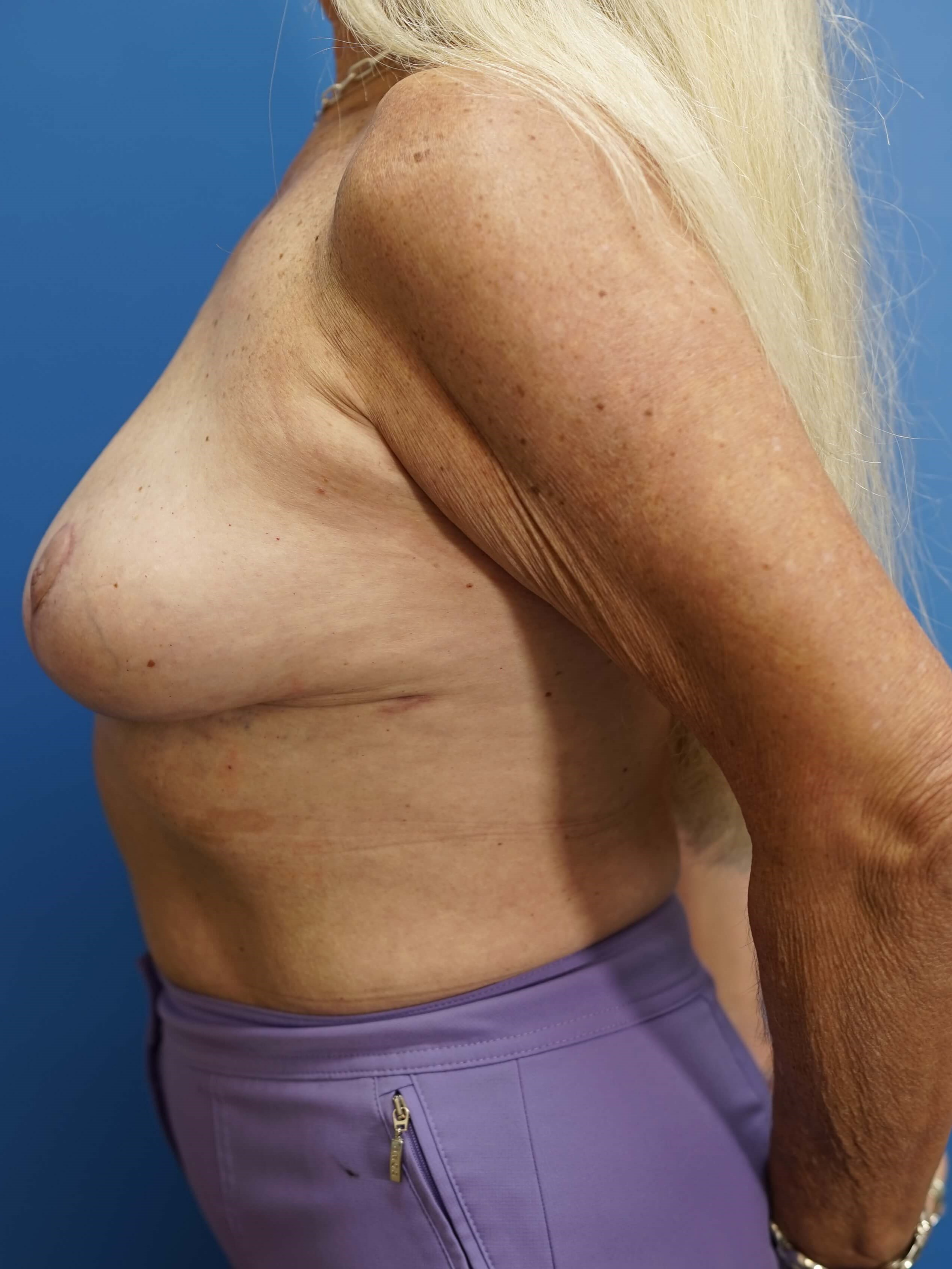 Woman Has Breast Reduction After