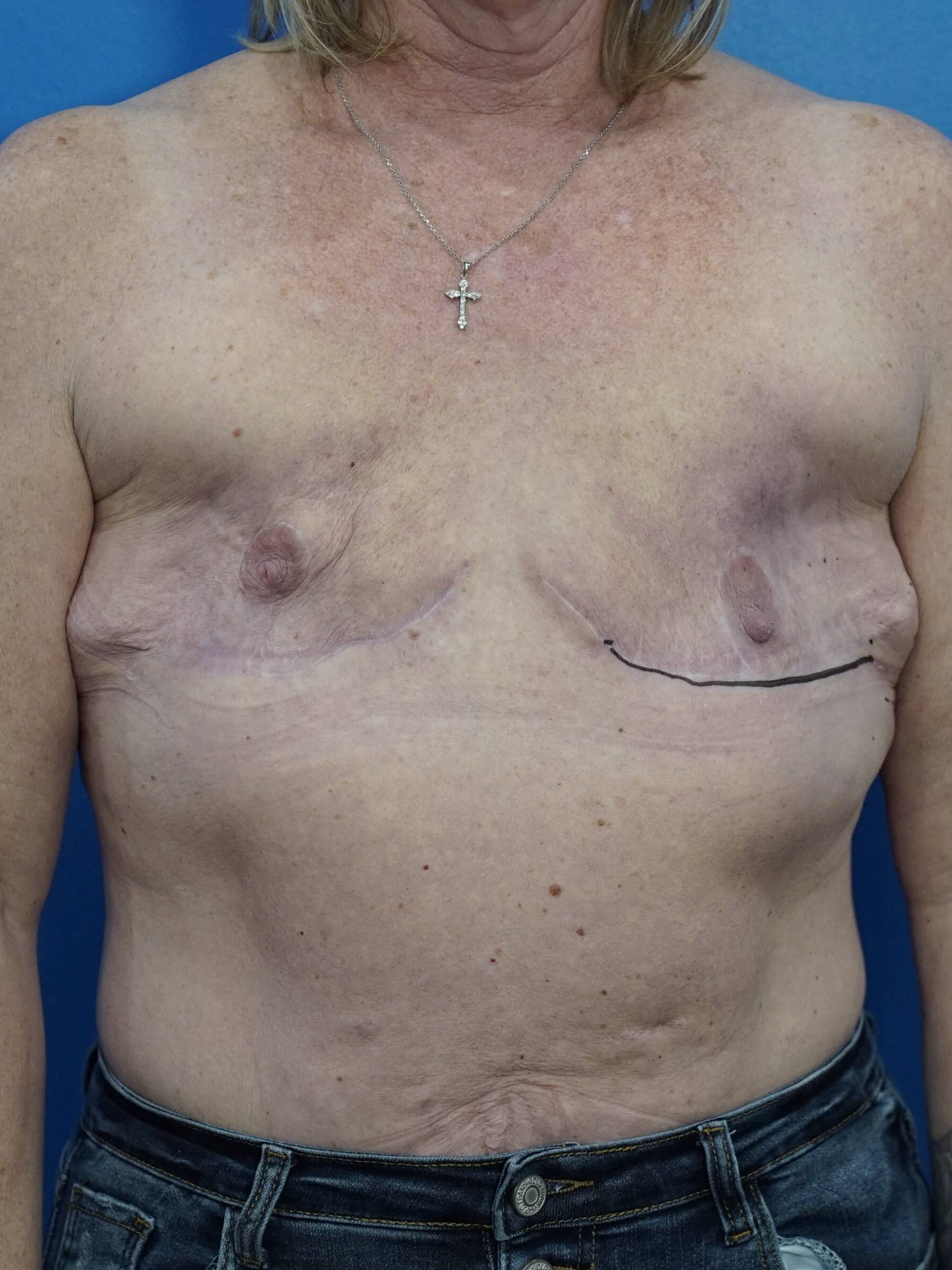 Woman Breast Reconstruction Before