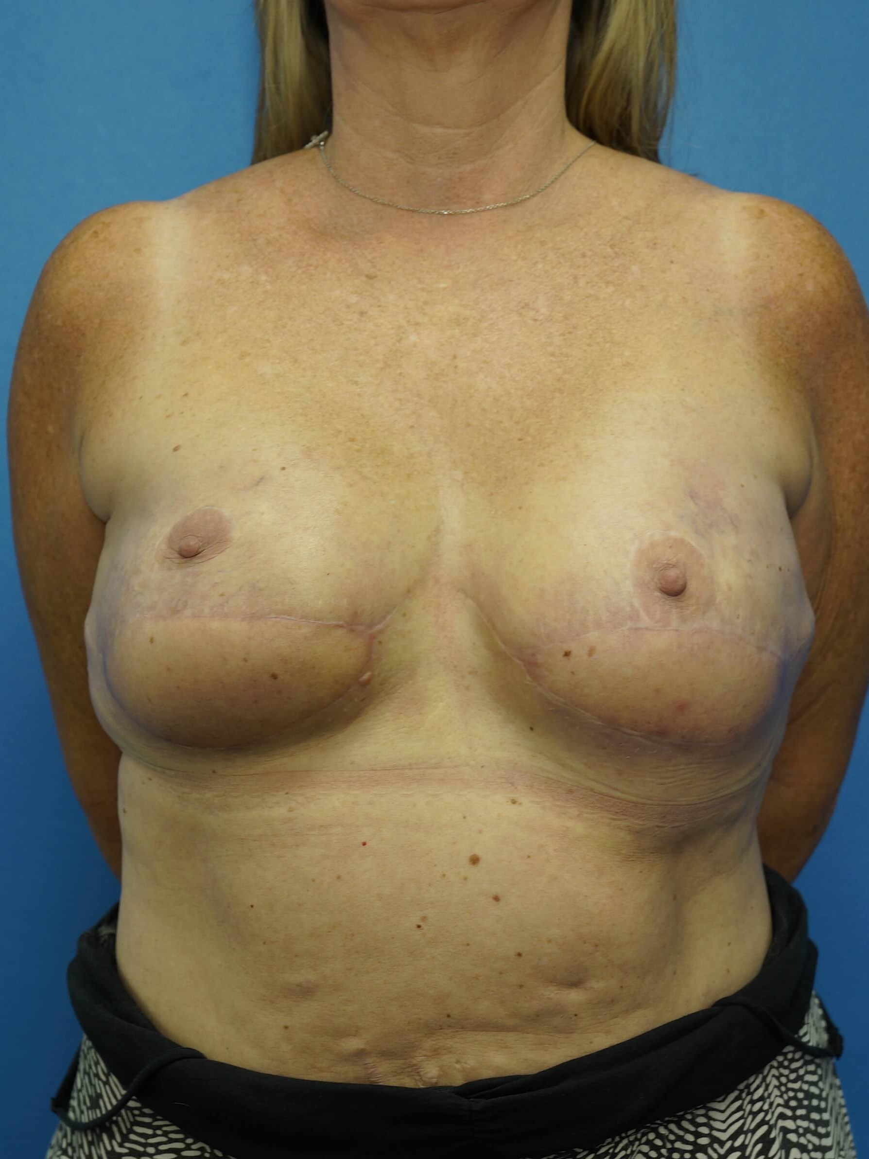 Woman Breast Reconstruction After