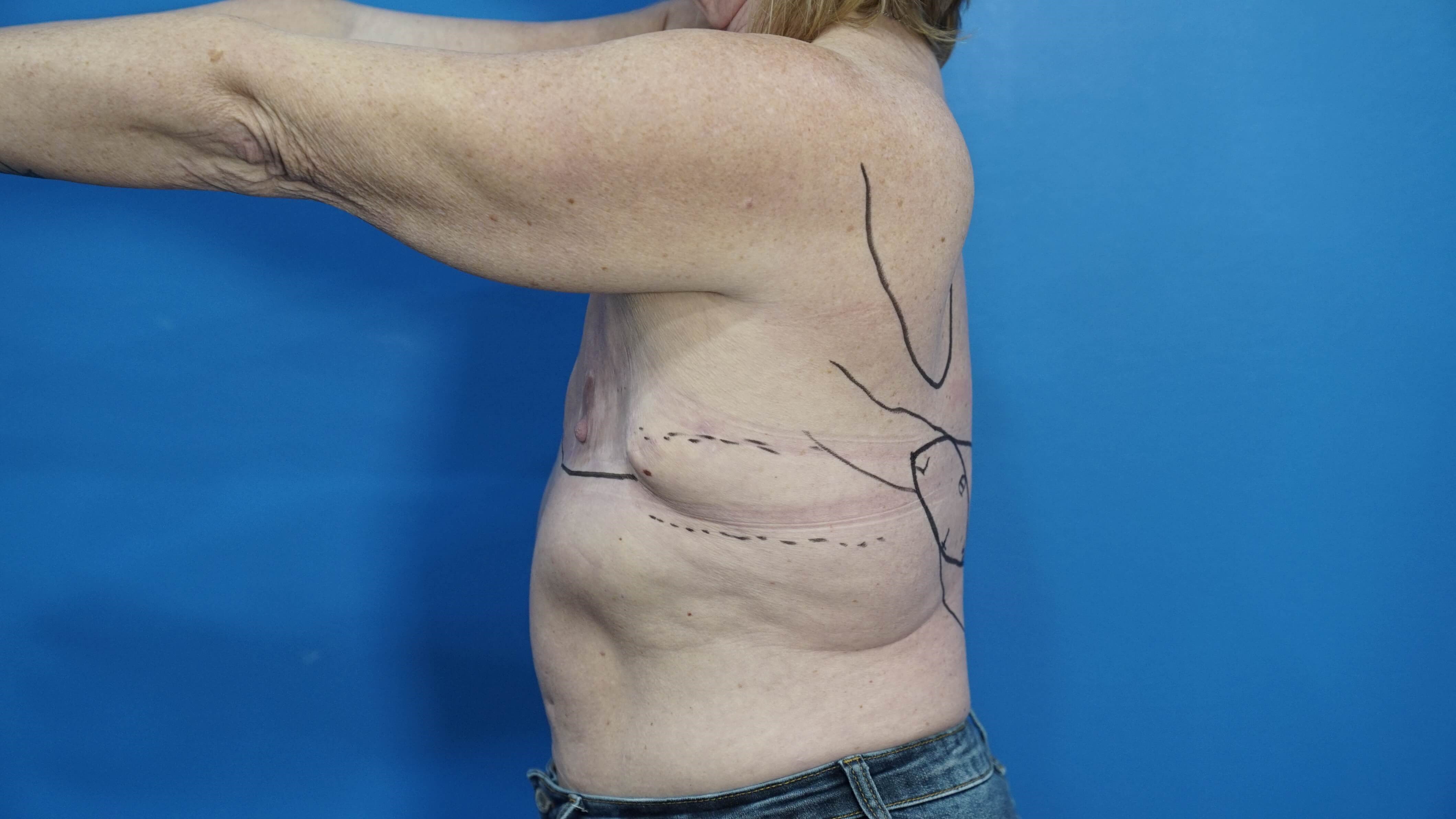 Woman Breast Reconstruction Before
