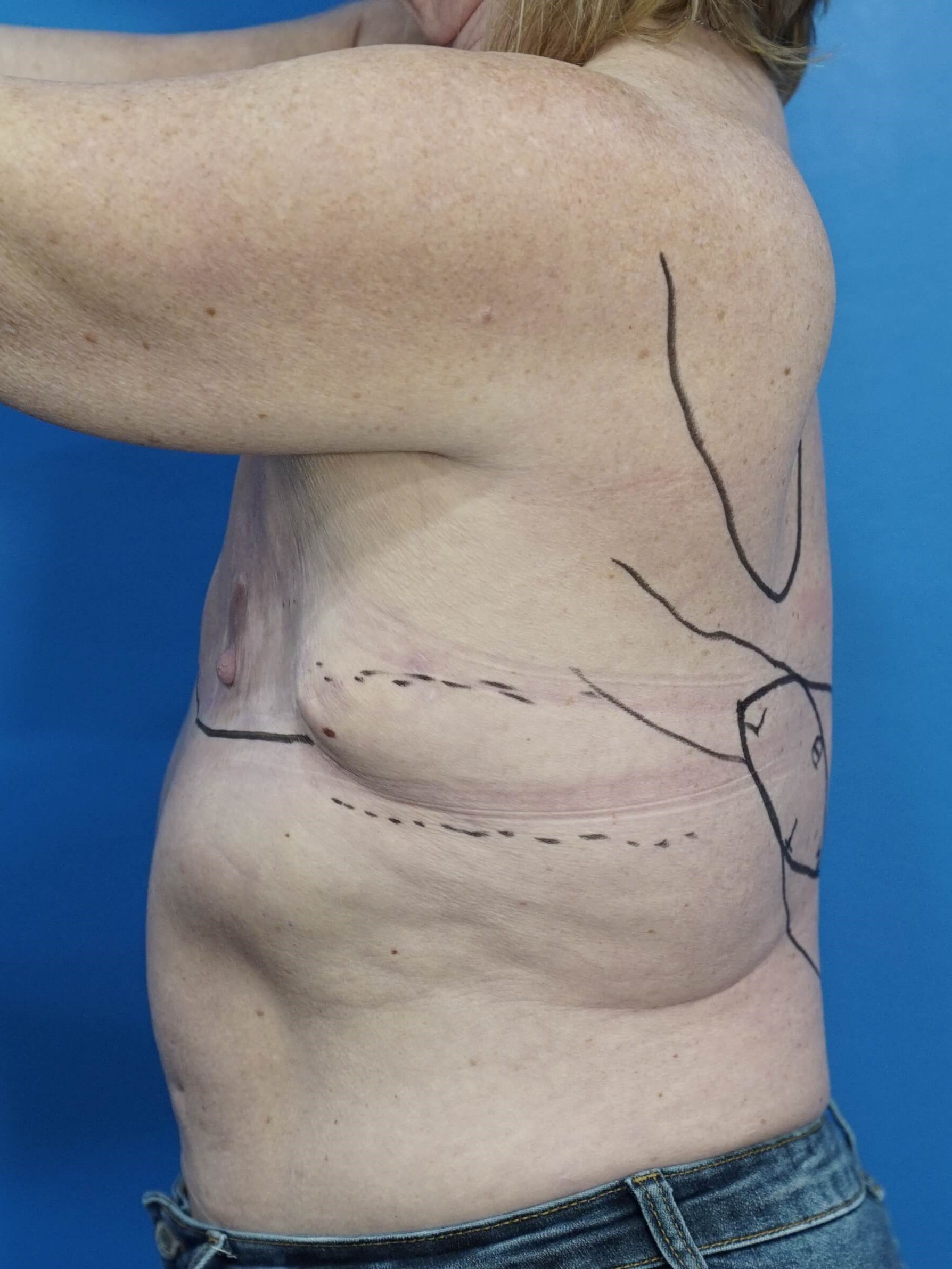 Woman Breast Reconstruction Before