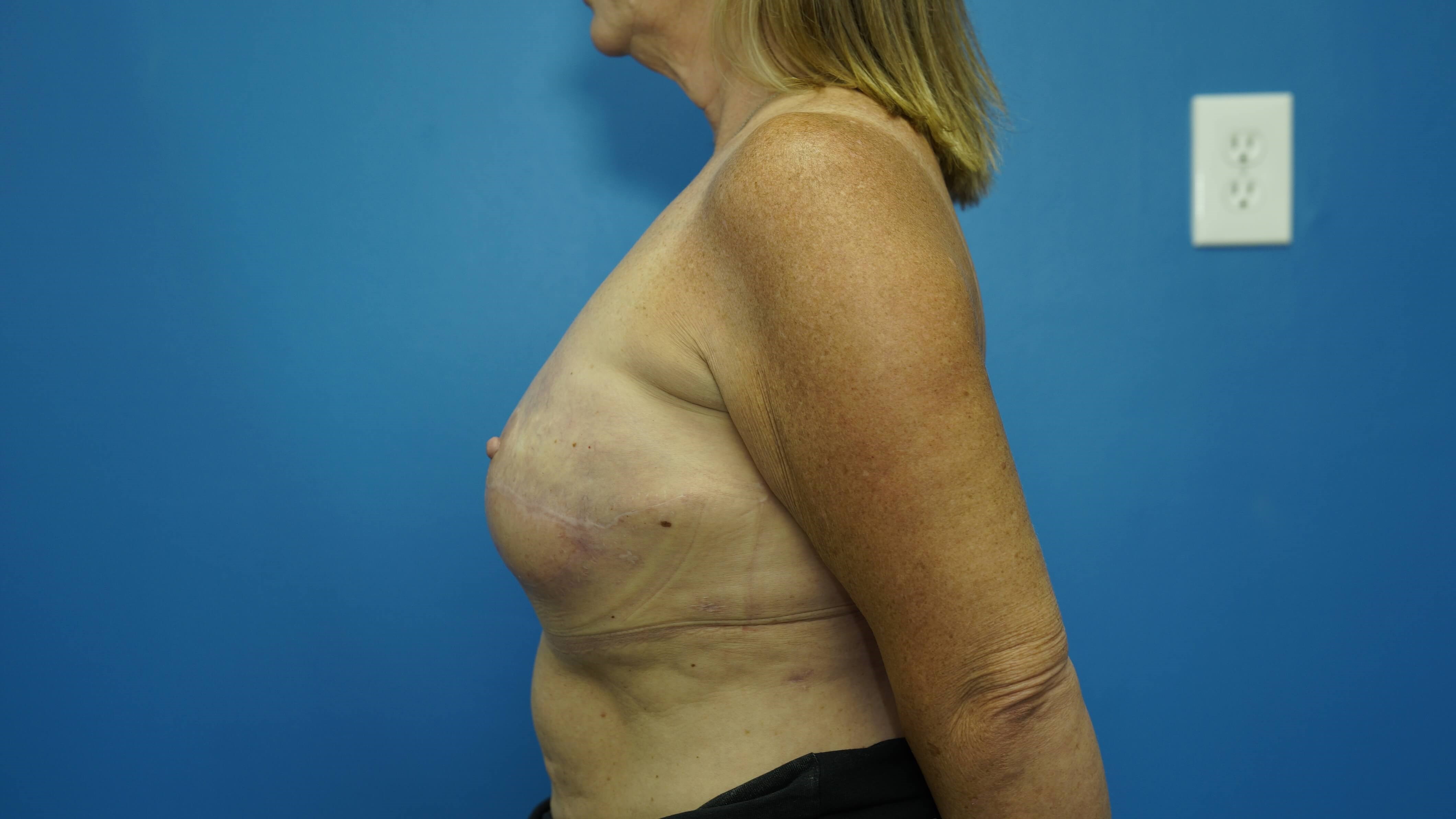 Woman Breast Reconstruction After