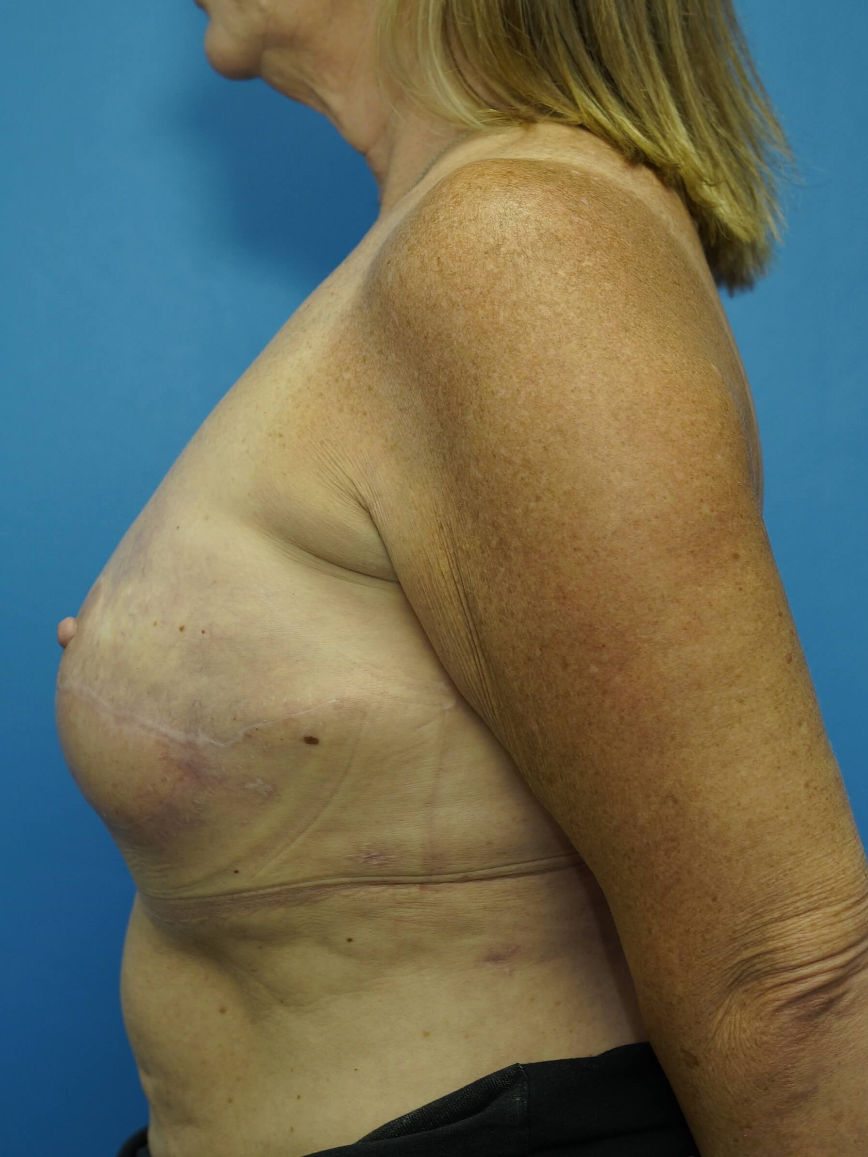 Woman Breast Reconstruction After