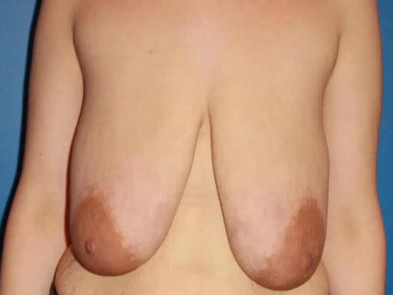 Augmentation with Lift Before