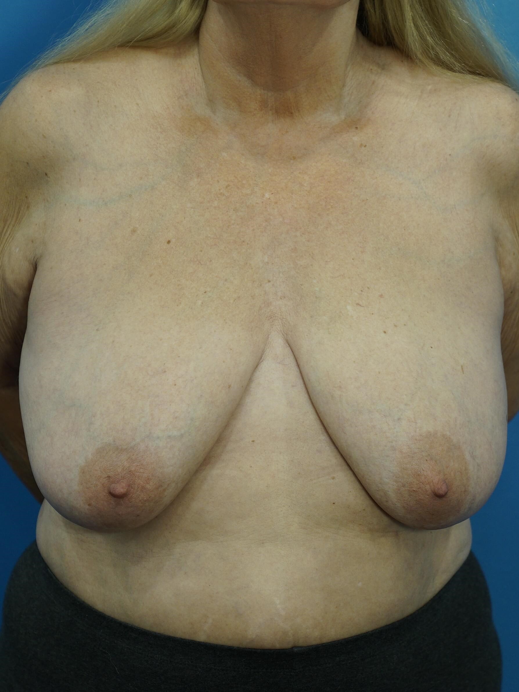 Breast Lift with Reduction Before