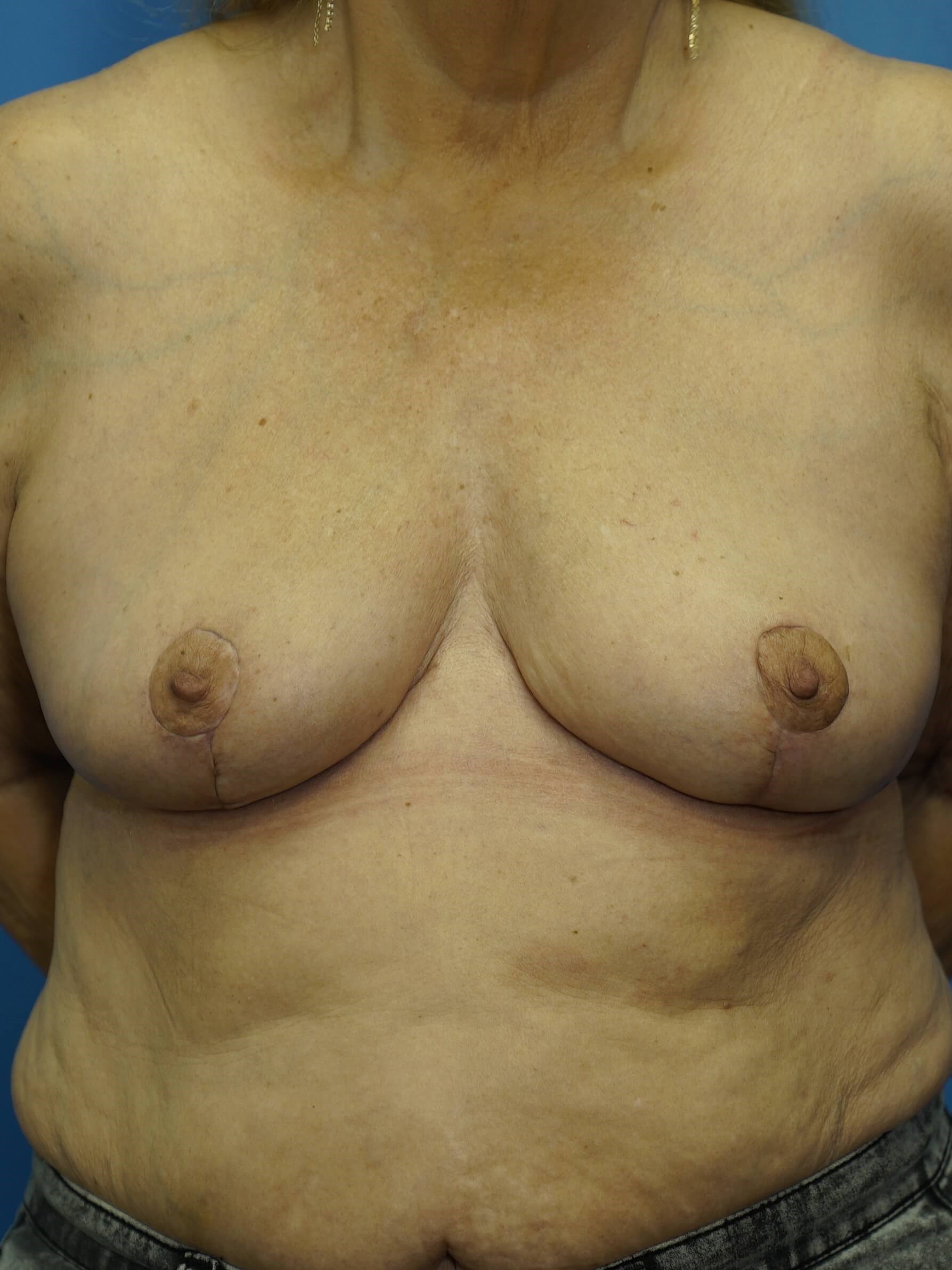Breast Lift with Reduction After