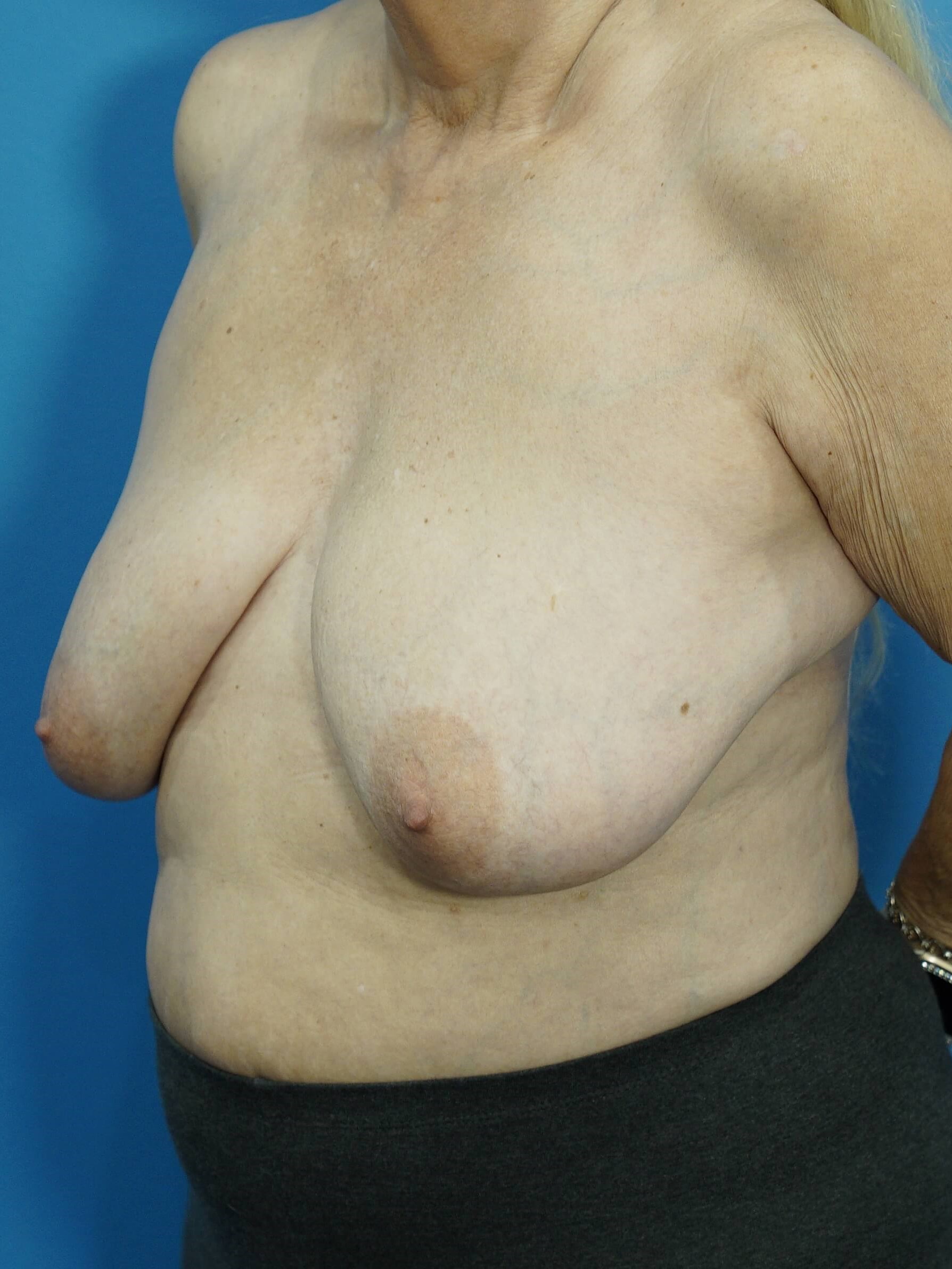 Breast Lift with Reduction Before
