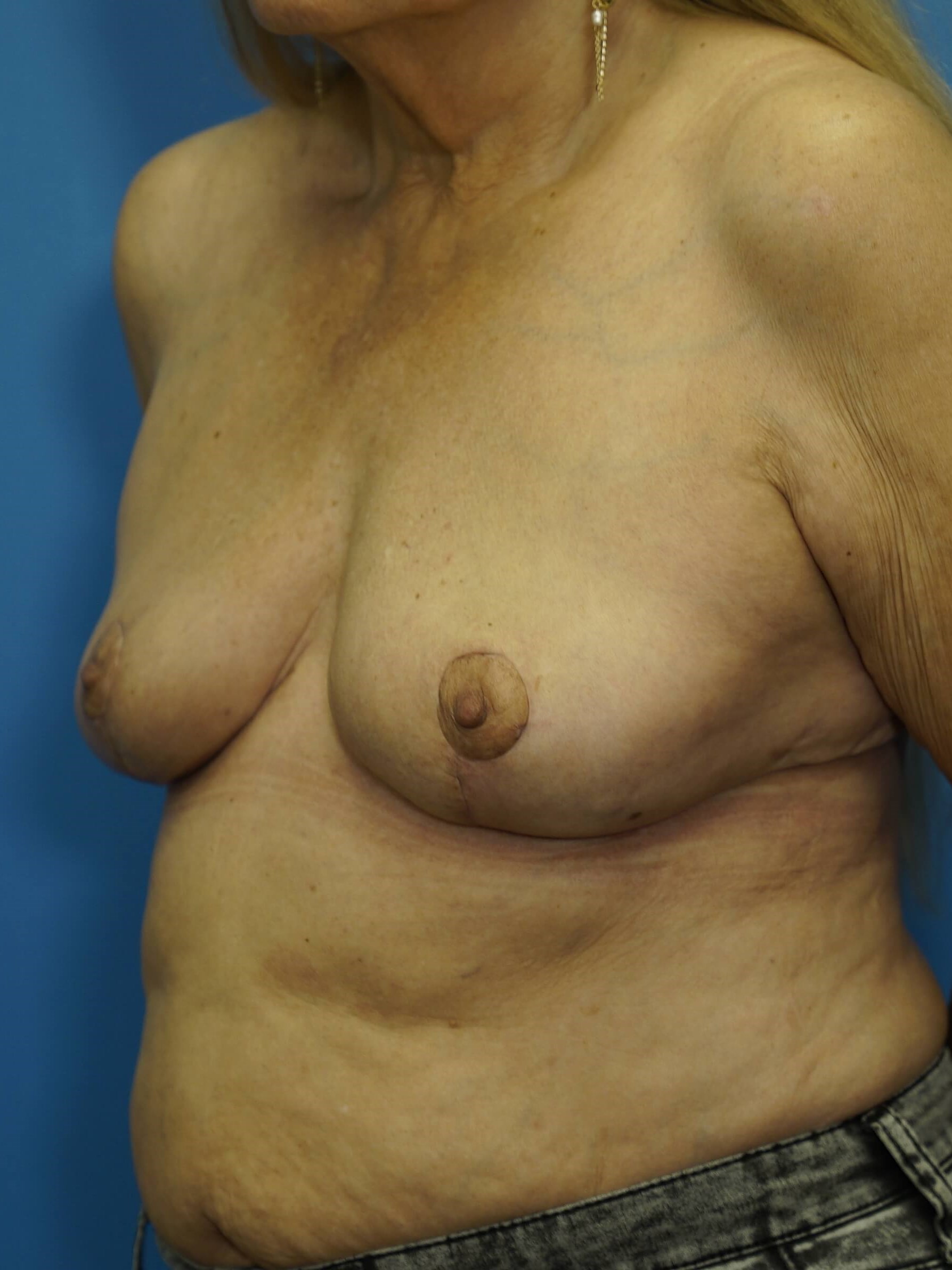 Breast Lift with Reduction After