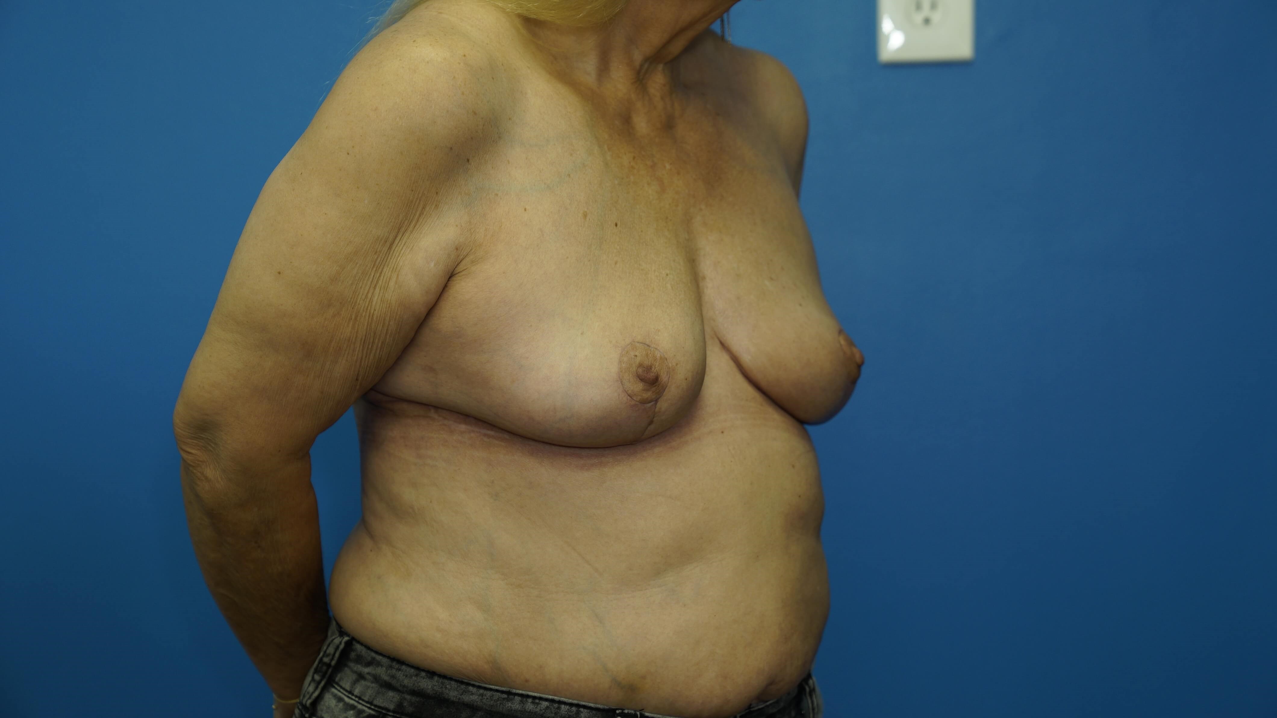 Breast Lift with Reduction After
