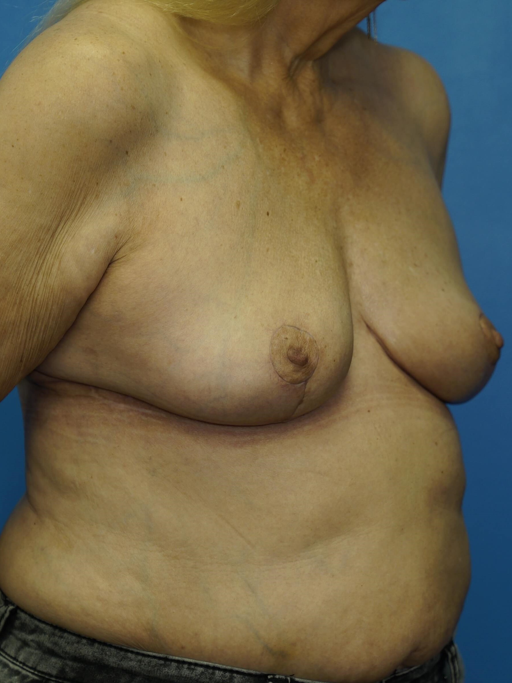 Breast Lift with Reduction After