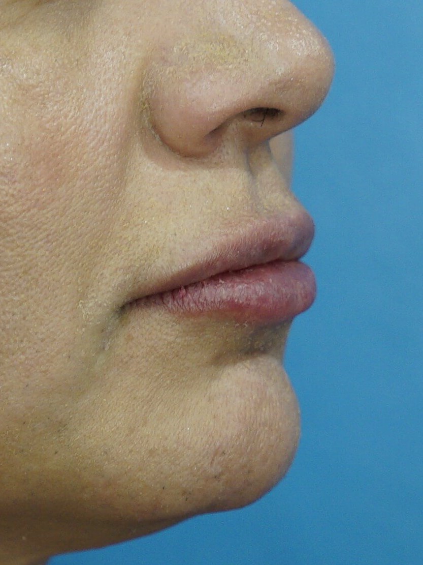 Lip Filler Before & After After
