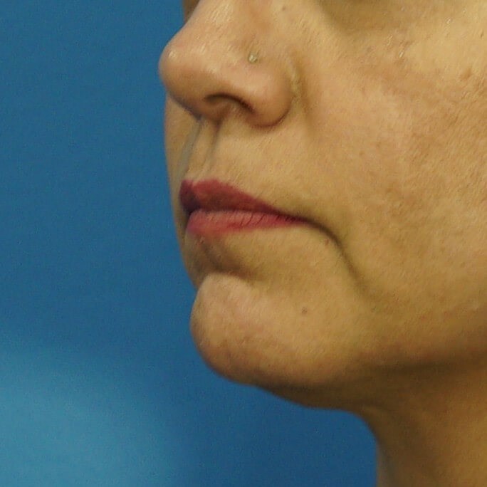 Lip Filler Before & After Before